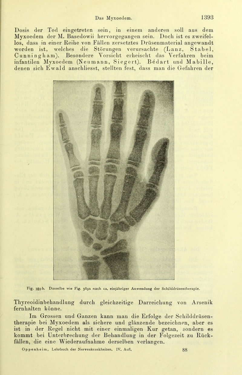Dosis der Tod eingetreten sein, in einem anderen soll aus dem Myxoedem der M. Basedowii hervorgegangen sein. Doch ist es zweifel- los, dass in einer Reihe von Fällen zersetztes Drüsenmaterial angewandt worden ist, welches die Störungen verursachte (Lanz, Stabei, Cunningham). Besondere Vorsicht erheischt das Verfahren beim infantilen Myxoedem (Neumann, Siegert). Bedart und Mabille, denen sich Ewald anschliesst, stellten fest, dass man die Gefahren der Fig. 389b. Dasselbe wie Fig. 389a nach ca, einjähriger Anwendung der Schilddrüsentherapie. Thyreoidinbehandlung durch gleichzeitige Darreichung von Arsenik fernhalten könne. Im Grossen und Ganzen kann man die Erfolge der Schilddrüsen- therapie bei Myxoedem als sichere und glänzende bezeichnen, aber es ist in der Regel nicht mit einer einmaligen Kur getan, sondern es kommt bei Unterbrechung der Behandlung in der Folgezeit zu Rück- fällen, die eine Wiederaufnahme derselben verlangen. Oppenheim, Lehrbuch der Nervenkrankheiten, IV. Aufl, 38