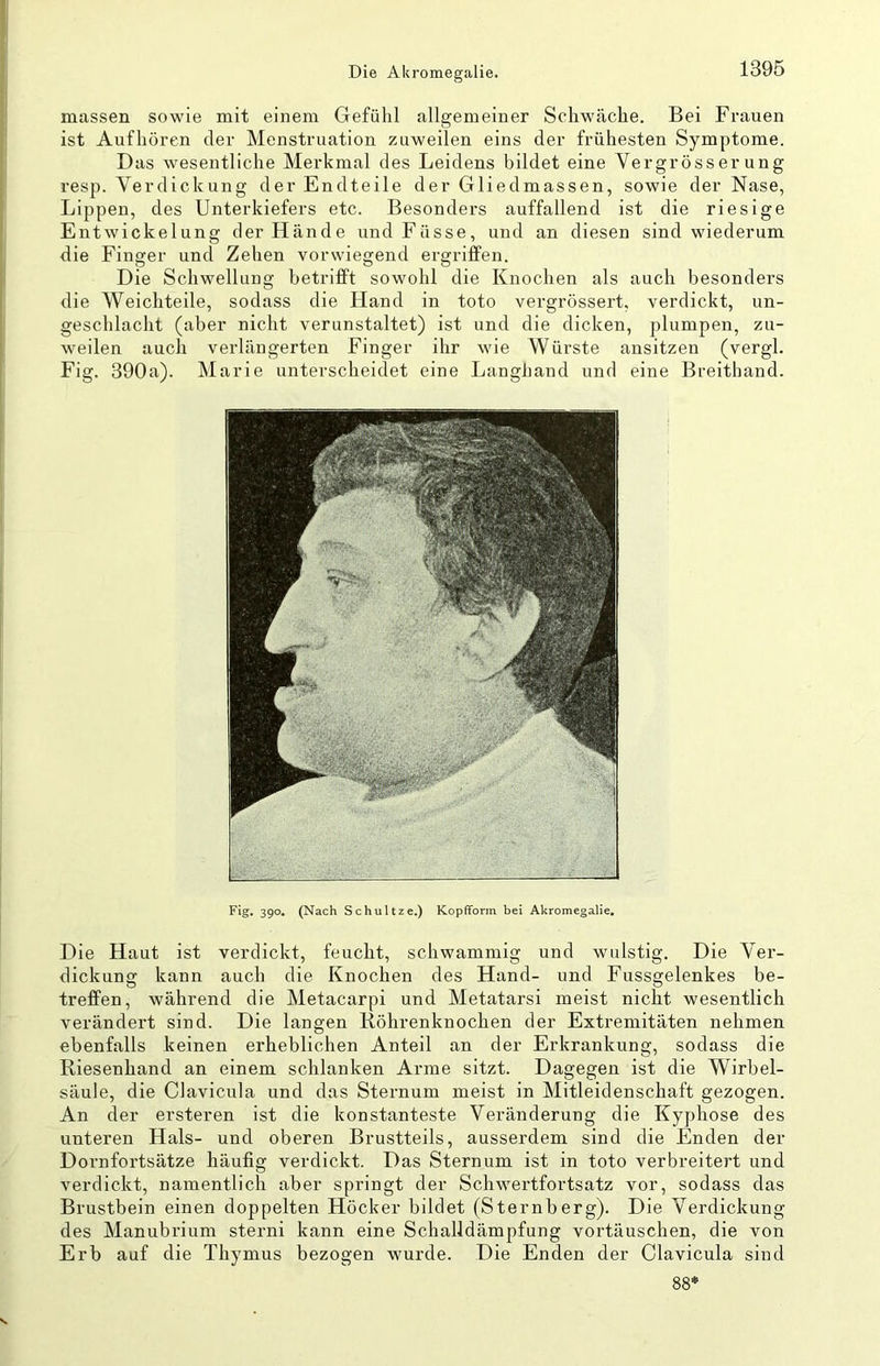 massen sowie mit einem Gefühl allgemeiner Schwäche. Bei Frauen ist Aufhören der Menstruation zuweilen eins der frühesten Symptome. Das wesentliche Merkmal des Leidens bildet eine Vergrösserung resp. Verdickung der Endteile der Gliedmassen, sowie der Nase, Lippen, des Unterkiefers etc. Besonders auffallend ist die riesige Entwickelung der Hände und Fasse, und an diesen sind wiederum die Finger und Zehen vorwiegend ergriffen. Die Schwellung betrifft sowohl die Knochen als auch besonders die Weichteile, sodass die Hand in toto vergrössert, verdickt, un- geschlacht (aber nicht verunstaltet) ist und die dicken, plumpen, zu- weilen auch verlängerten Finger ihr wie Würste ansitzen (vergl. Fig. 390a). Marie unterscheidet eine Langhand und eine Breithand. Fig, 390, (Nach Schultze.) Kopfform bei Akromegalie, Die Haut ist verdickt, feucht, schwammig und wulstig. Die Ver- dickung kann auch die Knochen des Hand- und Fussgelenkes be- treffen, während die Metacarpi und Metatarsi meist nicht wesentlich verändert sind. Die langen Köhrenknochen der Extremitäten nehmen ebenfalls keinen erheblichen Anteil an der Erkrankung, sodass die Riesenhand an einem schlanken Arme sitzt. Dagegen ist die Wirbel- säule, die Clavicula und das Sternum meist in Mitleidenschaft gezogen. An der ersteren ist die konstanteste Veränderung die Kyphose des unteren Hals- und oberen Brustteils, ausserdem sind die Enden der Dornfortsätze häufig verdickt. Das Sternum ist in toto verbreitert und verdickt, namentlich aber springt der Schwertfortsatz vor, sodass das Brustbein einen doppelten Höcker bildet (Sternberg). Die Verdickung des Manubrium sterni kann eine Schalldämpfung vortäuschen, die von Erb auf die Thymus bezogen wurde. Die Enden der Clavicula sind 88*