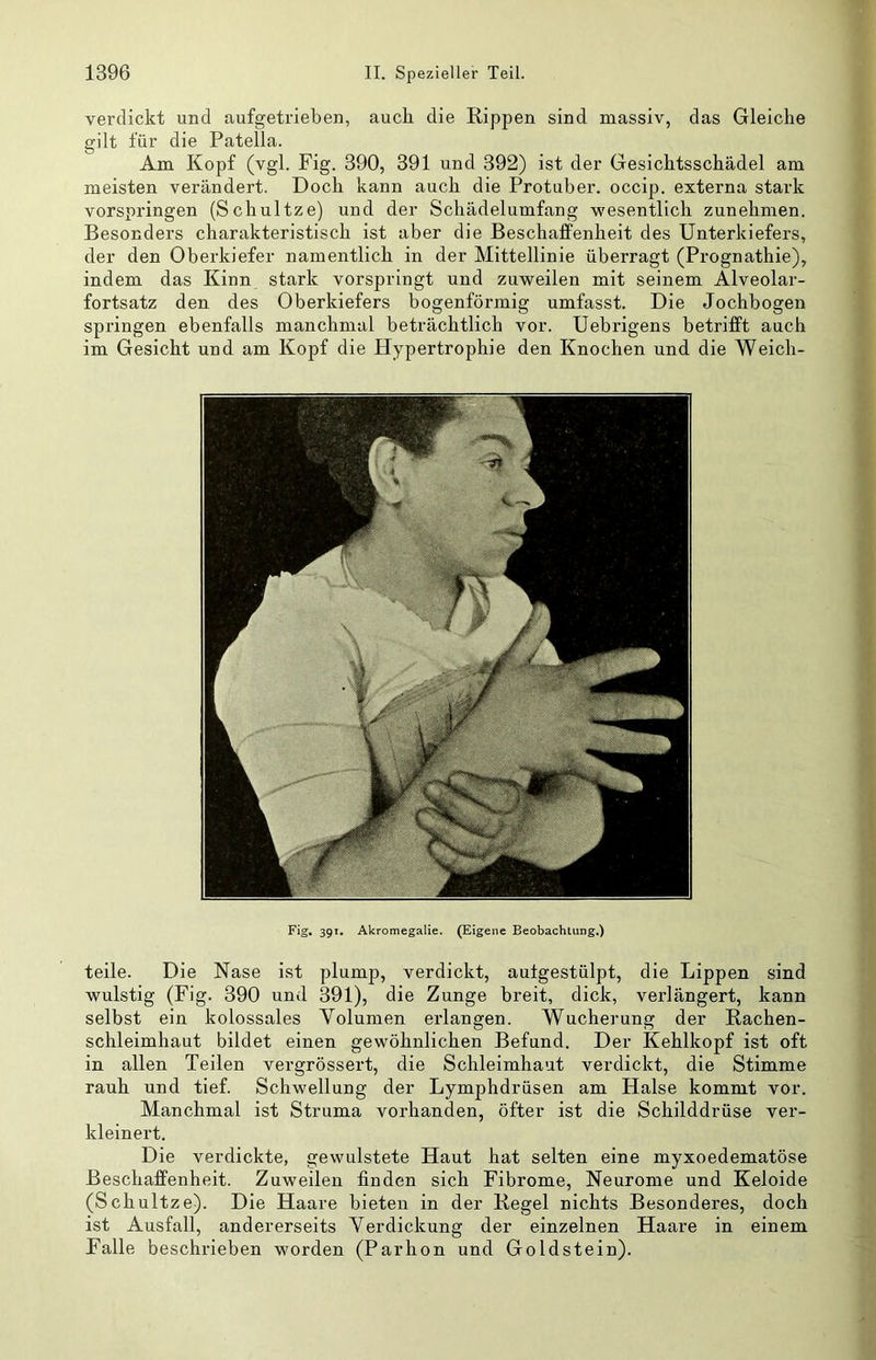 verdickt und aufgetrieben, auch die Rippen sind massiv, das Gleiche gilt für die Patella. Am Kopf (vgl. Fig. 390, 391 und 392) ist der Gesichtsschädel am meisten verändert. Doch kann auch die Protuber, occip. externa stark vorspringen (Schultze) und der Schädelumfang wesentlich zunehmen. Besonders charakteristisch ist aber die Beschaffenheit des Unterkiefers, der den Oberkiefer namentlich in der Mittellinie überragt (Prognathie), indem das Kinn stark vorspringt und zuweilen mit seinem Alveolar- fortsatz den des Oberkiefers bogenförmig umfasst. Die Jochbogen springen ebenfalls manchmal beträchtlich vor. Uebrigens betrifft auch im Gesicht und am Kopf die Hypertrophie den Knochen und die Weich- Fig, 391. Akromegalie. (Eigene Beobachtung.) teile. Die Nase ist plump, verdickt, aulgestülpt, die Lippen sind wulstig (Fig. 390 und 391), die Zunge breit, dick, verlängert, kann selbst ein kolossales Volumen erlangen. Wucherung der Rachen- schleimhaut bildet einen gewöhnlichen Befund. Der Kehlkopf ist oft in allen Teilen vergrössert, die Schleimhaut verdickt, die Stimme rauh und tief. Schwellung der Lymphdrüsen am Halse kommt vor. Manchmal ist Struma vorhanden, öfter ist die Schilddrüse ver- kleinert. Die verdickte, gewulstete Haut hat selten eine myxoedematöse Beschaffenheit. Zuweilen linden sich Fibrome, Neurome und Keloide (Schultze). Die Haare bieten in der Regel nichts Besonderes, doch ist Ausfall, andererseits Verdickung der einzelnen Haare in einem Falle beschrieben worden (Parhon und Goldstein).