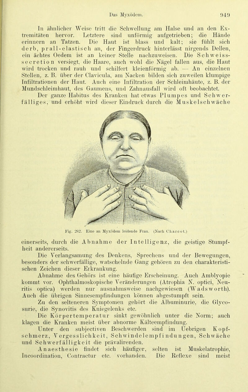 In ähnlicher Weise tritt die Schwellung am Halse und an den Ex- tremitäten hervor. Letztere sind unförmig aufgetrieben; die Hände erinnern an Tatzen. Die Haut ist blass und kalt; sie fühlt sich derb, prall-elastisch an, der Fingerdruck hinterlässt nirgends Dellen, ein achtes Oedem ist an keiner Stelle nachzuweisen. Die Schweiss- secretion versiegt, die Haare, auch wohl die Nägel fallen aus, die Haut wird trocken und rauh und schilfert kleienförmig ab. — An einzelnen Stellen, z. B. über der Clavicula, am Nacken bilden sich zuweilen klumpige Infiltrationen der Haut. Auch eine Infiltration der Schleimhäute, z. B. der Mundschleimhaut, des Gaumens, und Zahnausfall wird oft beobachtet. Der ganze Habitus des Kranken hat etwas Plumpes und Schwer- fälliges, und erhöht wird dieser Eindruck durch die Muskelschwäche Fig. 282. Eine an Myxödem leidende Frau. (Nach Charcot.) einerseits, durch die Abnahme der Intelligenz, die geistige Stumpf- heit andererseits. Die Verlangsamung des Denkens, Sprechens und der Bewegungen, besonders der schwerfällige, watschelnde Gang gehören zu den charakteristi- schen Zeichen dieser Erkrankung. Abnahme des Gehörs ist eine häufige Erscheinung. Auch Amblyopie kommt vor. Ophthalmoskopische Veränderungen (Atrophia N. optici, Neu- ritis optica) werden nur ausnahmsweise nachgewiesen (Wadsworth). Auch die übrigen Sinnesempfindungen können abgestumpft sein. Zu den selteneren Symptomen gehört die Albuminurie, die Glvco- surie, die Synovitis des Kniegelenks etc. Die Körpertemperatur sinkt gewöhnlich unter die Norm; auch klagen die Kranken meist über abnorme Kälteempfindung. Unter den subjectiven Beschwerden sind im Uebrigen Kopf- schmerz, Vergesslichkeit, Schwindelempfindungen, Schwäche und Schwerfälligkeit die prävalirenden. Anaesthesie findet sich häufiger, selten ist Muskelatrophie, Incoordination, Contractur etc. vorhanden. Die Reflexe sind meist