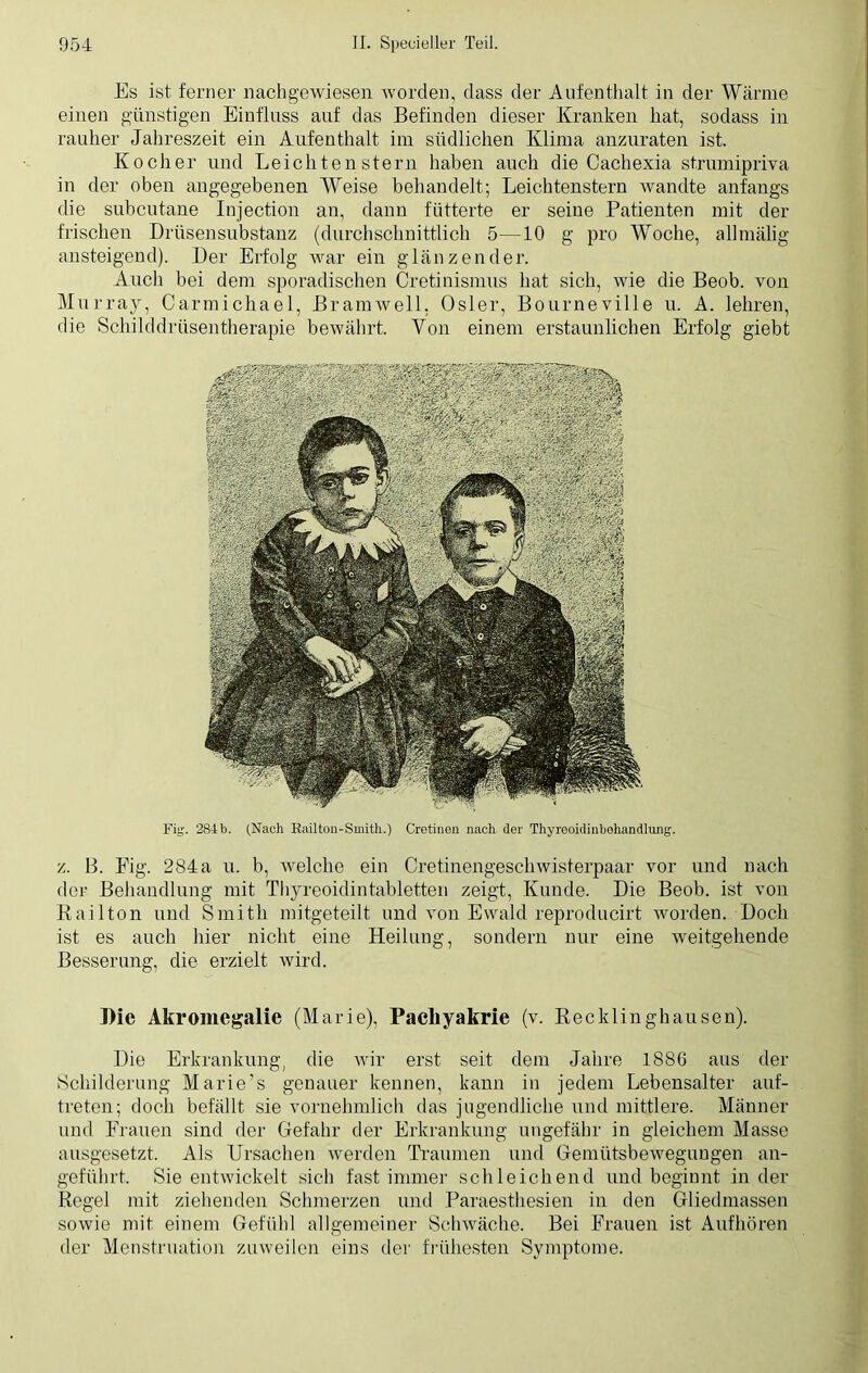 Es ist ferner nachgewiesen worden, dass der Aufenthalt in der Wärme einen günstigen Einfluss auf das Befinden dieser Kranken hat, sodass in rauher Jahreszeit ein Aufenthalt im südlichen Klima anzuraten ist. Kocher und Leichten Stern haben auch die Cachexia strumipriva in der oben angegebenen Weise behandelt; Leichtenstern wandte anfangs die subcutane Injection an, dann fütterte er seine Patienten mit der frischen Drüsensubstanz (durchschnittlich 5—10 g pro Woche, allmälig ansteigend). Der Erfolg war ein glänzender. Auch bei dem sporadischen Cretinismus hat sich, wie die Beob. von Murray, Carmichael, Bramwell. Osler, Bourneville u. A. lehren, die Schilddrüsentherapie bewährt. Von einem erstaunlichen Erfolg giebt Fig. 284b. (Nach Railton-Smith.) Cretinen nach der Thyreoidmbehandlung. z. B. Fig. 284a u. b, rvelche ein Cretinengeschwisterpaar vor und nach der Behandlung mit Thyreoidintabletten zeigt, Kunde. Die Beob. ist von Railton und Smith mitgeteilt und von Ewald reproducirt worden. Doch ist es auch hier nicht eine Heilung, sondern nur eine weitgehende Besserung, die erzielt wird. Die Akromegalie (Marie), Pacliyakrie (v. Recklinghausen). Die Erkrankung, die wir erst seit dem Jahre 1886 aus der Schilderung Marie’s genauer kennen, kann in jedem Lebensalter auf- treten; doch befällt sie vornehmlich das jugendliche und mittlere. Männer und Frauen sind der Gefahr der Erkrankung ungefähr in gleichem Masse ausgesetzt. Als Ursachen werden Traumen und Gemütsbewegungen an- geführt. Sie entwickelt sich fast immer schleichend und beginnt in der Regel mit ziehenden Schmerzen und Paraesthesien in den Gliedmassen sowie mit einem Gefühl allgemeiner Schwäche. Bei Frauen ist Aufhören der Menstruation zuweilen eins der frühesten Symptome.