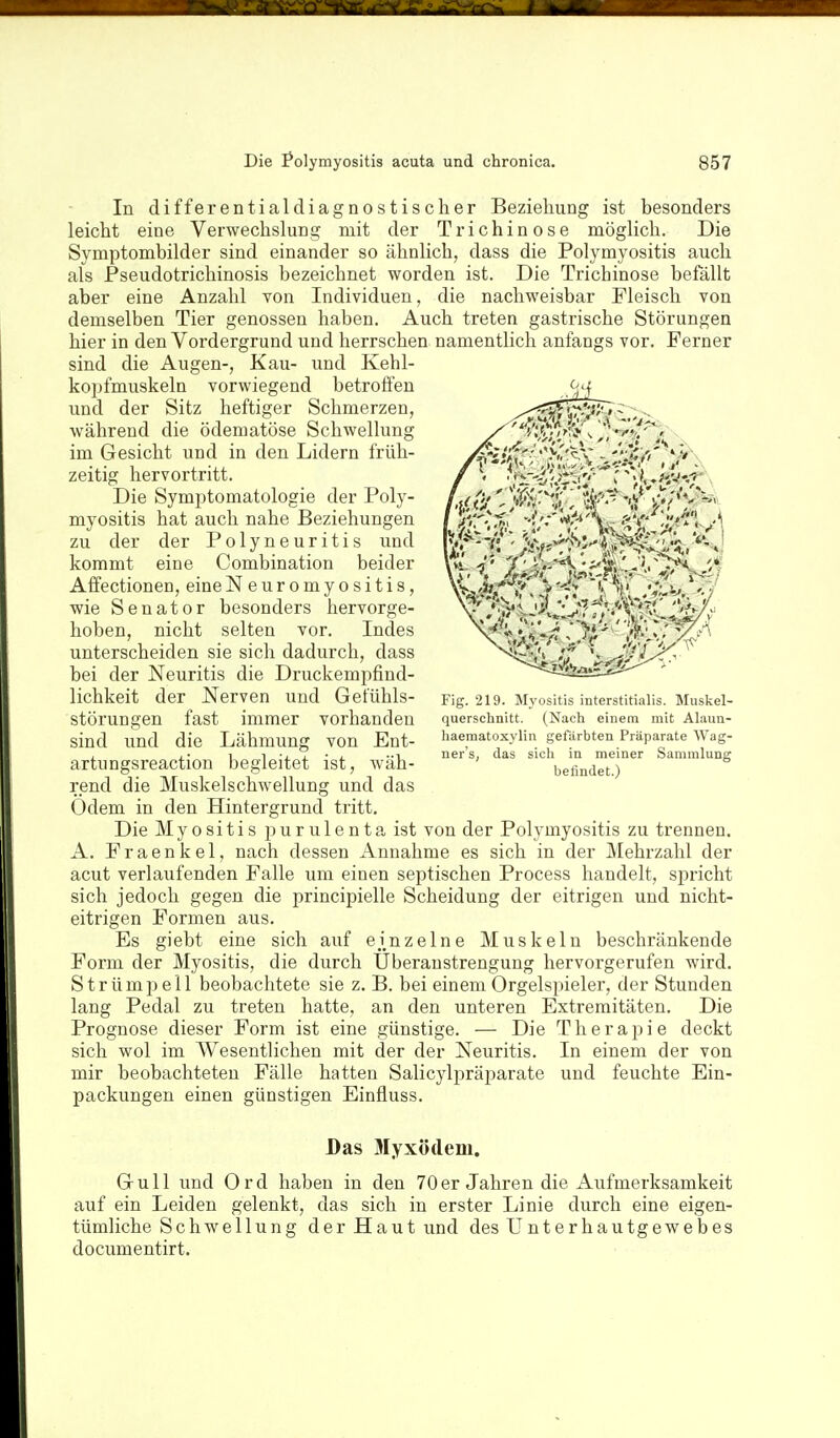 In differentialdiagnostischer Beziehung ist besonders leicht eine Verwechslung mit der Trichinose möglich. Die Symptombilder sind einander so ähnlich, dass die Polymyositis auch als Pseudotrichinosis bezeichnet worden ist. Die Trichinose befällt aber eine Anzahl von Individuen, die nachweisbar Fleisch von demselben Tier genossen haben. Auch treten gastrische Störungen hier in den Vordergrund und herrschen namentlich anfangs vor. Ferner sind die Augen-, Kau- und Kehl- koj^fmuskeln vorwiegend betroffen und der Sitz heftiger Schmerzen, während die ödematöse Schwellung im Gesicht und in den Lidern früh- zeitig hervortritt. Die Symi^tomatologie der Poly- myositis hat auch nahe Beziehungen zu der der Polyneuritis und kommt eine Combination beider Affectionen, eineNeuromyositis, wie Senator besonders hervorge- hoben, nicht selten vor. Indes unterscheiden sie sich dadurch, dass bei der Neuritis die Druckemiifind- lichkeit der Nerven und Gefühls- störungen fast immer vorhanden sind und die Lähmung von Ent- artuDgsreaction begleitet ist, wäh- rend die Muskelschwellung und das Odem in den Hintergrund tritt. Die Myositis p u r u 1 e n t a ist von der Polymyositis zu trennen. A. Fraenkel, nach dessen Annahme es sich in der Mehrzahl der acut verlaufenden Falle um einen septischen Process handelt, spricht sich jedoch gegen die principielle Scheidung der eitrigen und nicht- eitrigen Formen aus. Es giebt eine sich auf ej^nzelne Muskeln beschränkende Form der Myositis, die durch Überanstrengung hervorgerufen wird. Strümpell beobachtete sie z. B. bei einem Orgelspieler, der Stunden lang Pedal zu treten hatte, an den unteren Extremitäten. Die Prognose dieser Form ist eine günstige. — Die Therapie deckt sich wol im Wesentlichen mit der der Neuritis. In einem der von mir beobachteten Fälle hatten Salicylpräparate und feuchte Ein- packungen einen günstigen Einfluss. Fig. 219. Myositis interstitialis. Muskel- querschnitt. (Nach einem mit Alaun- haematoxylin gefärbten Präparate Wag- ner's, das sich in meiner Sammlung befindet.) Das Myxödem. Gull und Ord haben in den 70er Jahren die Aufmerksamkeit auf ein Leiden gelenkt, das sich in erster Linie durch eine eigen- tümliche Schwellung der Haut und des Unter hau tgeweb es documentirt.