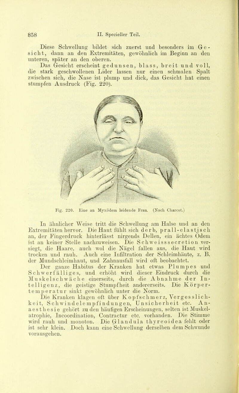 Diese Schwellung bildet sich zuerst und besonders im Gre- sicht, dann an den Extremitäten, gewöhnlich im Beginn an den unteren, später an den oberen. Das Gi-esicht erscheint gedunsen, blass, breit und voll, die stark geschwollenen Lider lassen nur einen schmalen Spalt zwischen sich, die Nase ist plump und dick, das Gesicht hat einen stumpfen Ausdruck (Fig. 220). Fig. 220. Eine an Mjrxödein leidende Frau. (Nach Cliarcot.) In ähnlicher Weise tritt die Schwellung am Halse und an den Extremitäten hervor. Die Haut fühlt sich derb, prall-elastisch an, der Fingerdruck hinterlässt nirgends Dellen, ein ächtes Odem ist an keiner Stelle nachzuweisen. Die Schweisssecretion ver- siegt, die Haare, auch wol die Nägel fallen aus, die Haut wird trocken und rauh. Auch eine Infiltration der Schleimhäute, z. B. der Mundschleimhaut, und Zahnausfall wird oft beobachtet. Der ganze Habitus der Kranken hat etwas Plumpes und Schwerfälliges, und erhöht wird dieser Eindruck durch die Muskelschwäche einerseits, durch die Abnahme der In- telligenz, die geistige Stumpfheit andererseits. Die Körper- temj^eratur sinkt gewöhnlich unter die Norm. Die Kranken klagen oft über Kopfschmerz, Verges slich- keit, Schwindelempfindungen, Unsicherheit etc. An- aesthesie gehört zu den häufigen Erscheinungen, selten ist Muskel- atrophie, Incoordination, Contractur etc. vorhanden. Die Stimme wird rauh und monoton. Die Grlandula thyreoidea fehlt oder ist sehr klein. Doch kann eine Schwellung derselben dem Schwunde vorausgehen.