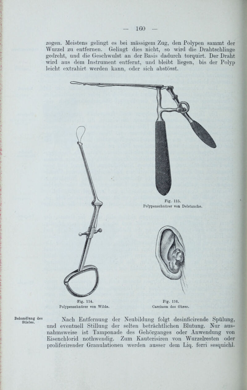 zogen. Meistens gelingt es bei mässigem Zug, den Polypen sammt der Wurzel zu entfernen. Gelingt dies nicht, so wird die Drahtschlinge gedreht, und die Geschwulst an der Basis dadurch torquirt. Der Draht wird aus dem Instrument entfernt, und bleibt liegen, bis der Polyp leicht extrahirt werden kann, oder sich abstösst. Fig. 114. Fig. 116. Polypenschnürer von Wilde. Carcinom des Ohres. Bebast1eiesS des Nach Entfernung der Neubildung folgt desinficirende Spülung, und eventuell Stillung der selten beträchtlichen Blutung. Nur aus- nahmsweise ist Tamponade des Gehörganges oder Anwendung von Eisenchlorid nothwendig. Zum Kauterisiren von Wurzelresten oder proliferirender Granulationen werden ausser dem Liq. ferri sesquichl.