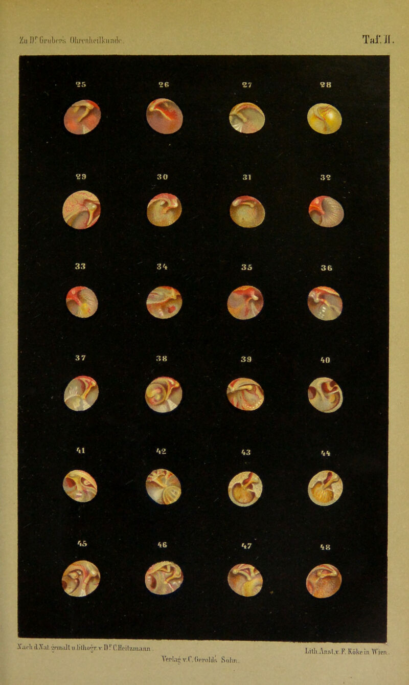 ’/a\ DrGnibrrs Ohrcnheilkundr. Taf. Jl .V.n li '.Tin,dl ii lilhor. v lüT.Heil’Aituum Verla? v.C.(irrnlds Snlin Lilli Ansl.v, R Koke in Wien