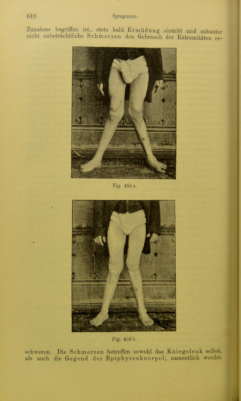 Zunahme begriffen ist, stets bald Ermüdung eintritt und mitunter nicht unbeträchtliche Schmerzen den Gebrauch der Extremitäten er- Fig. 456 b. schweren. Die Schmerzen betreffen sowohl das Kniegelenk selbst, als auch die Gegend der Epiphysenknorpel; namentlich werden