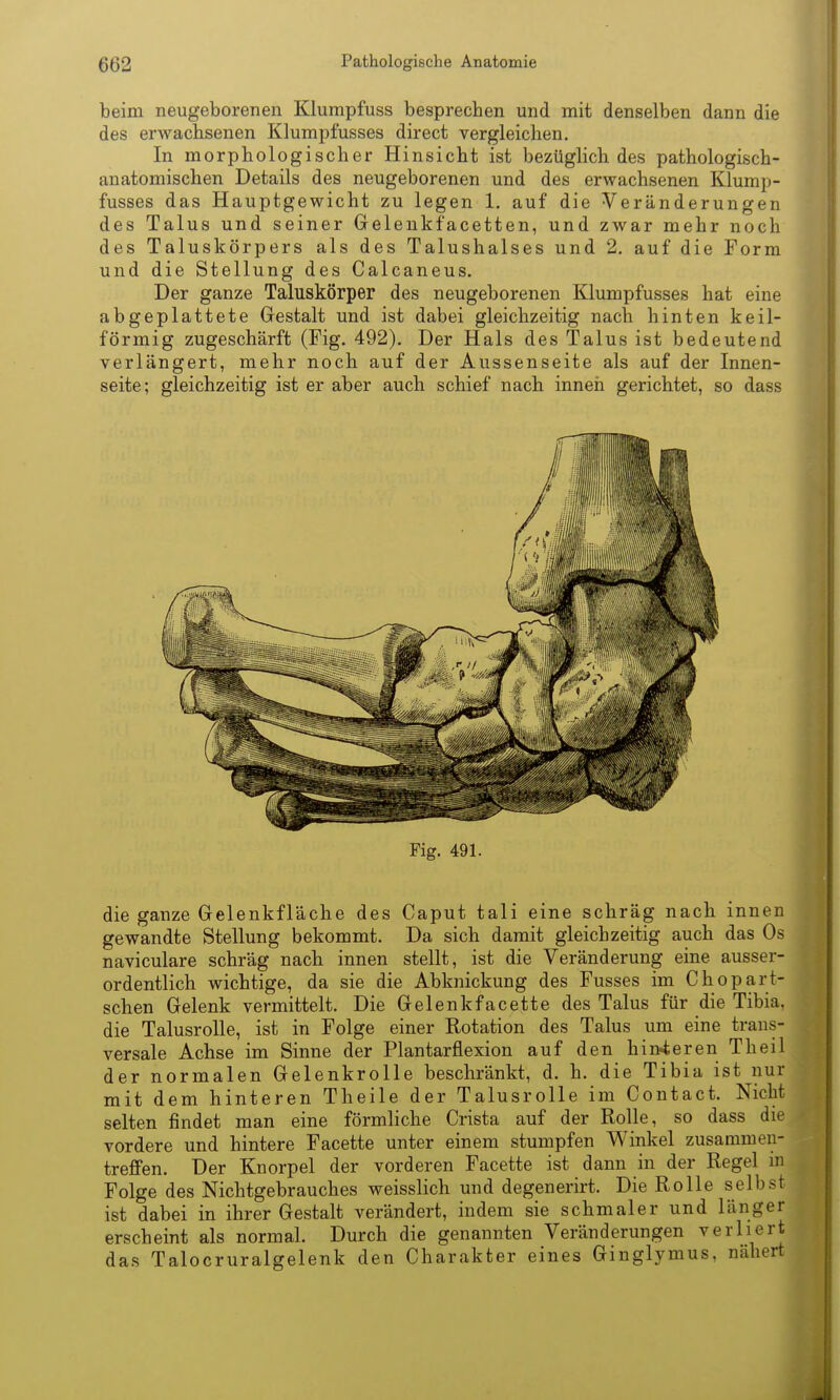 beim neugeborenen Klumpfuss besprechen und mit denselben dann die des erwachsenen Klumpfusses direct vergleichen. In morphologischer Hinsicht ist bezüglich des pathologisch- anatomischen Details des neugeborenen und des erwachsenen Klump- fusses das Hauptgewicht zu legen 1. auf die Veränderungen des Talus und seiner Grelenkfacetten, und zwar mehr noch des Taluskörpers als des Talushalses und 2, auf die Form und die Stellung des Calcaneus. Der ganze Taluskörper des neugeborenen Klumpfusses hat eine abgeplattete Gestalt und ist dabei gleichzeitig nach hinten keil- förmig zugeschärft (Fig. 492). Der Hals des Talus ist bedeutend verlängert, mehr noch auf der Aussenseite als auf der Innen- seite; gleichzeitig ist er aber auch schief nach innen gerichtet, so dass Fig. 491. die ganze Gelenkfläche des Caput tali eine schräg nach innen gewandte Stellung bekommt. Da sich damit gleichzeitig auch das Os naviculare schräg nach innen stellt, ist die Veränderung eine ausser- ordentlich wichtige, da sie die Abknickung des Fusses im Chopart- schen Gelenk vermittelt. Die Gelenkfacette des Talus für die Tibia, die TalusroUe, ist in Folge einer Rotation des Talus um eine trans- versale Achse im Sinne der Plantarflexion auf den hinneren Theil der normalen Gelenkrolle beschränkt, d. h. die Tibia ist nur mit dem hinteren Theile der Talusrolle im Contact. Nicht selten findet man eine förmliche Crista auf der Rolle, so dass die vordere und hintere Facette unter einem stumpfen Winkel zusammen- treffen. Der Knorpel der vorderen Facette ist dann in der Regel m Folge des Nichtgebrauches weisslich und degenerirt. Die Rolle selbst ist dabei in ihrer Gestalt verändert, indem sie schmaler und länger erscheint als normal. Durch die genannten Veränderungen verliert das Talocruralgelenk den Charakter eines Ginglymus, nähert