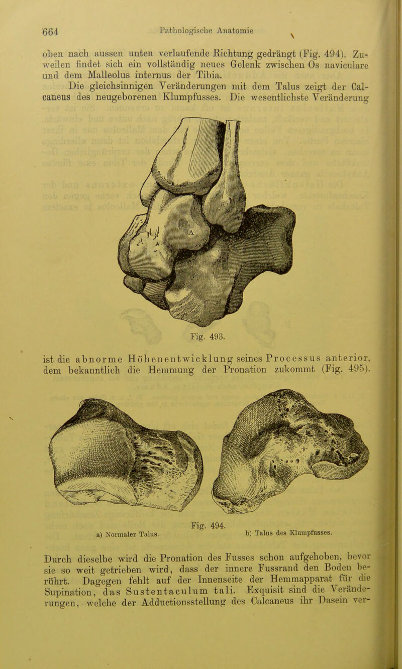 \ oben nach aussen unten verlaufende Richtung gedrängt (Fig. 494). Zu- weilen findet sich ein vollständig neues Gelenk zwischen Os naviculare und dem Malleolus internus der Tibia. Die gleichsinnigen Veränderungen mit dem Talus zeigt der Cal- caneus des neugeborenen Klumpfusses. Die wesentlichste Veränderung Fig. 493. ist die abnorme Höhenentwicklung seines Processus anterior, dem bekanntlich die Hemmung der Pronation zukommt (Fig. 495). Fig. 494. a) Normaler Talus. b) Talus des Klumpfusses. Durch dieselbe wird die Pronation des Fusses schon aufgehoben, bevor sie so weit getrieben wird, dass der innere Fussrand den Boden be- rührt. Dagegen fehlt auf der Innenseite der Hemmapparat für die Supination, das Sustentaculum tali. Exquisit sind die Verände- rungen, welche der Adductionsstellung des Calcaneus ihr Dasein ver-