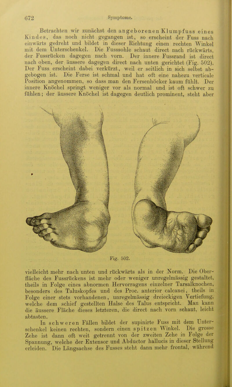 Betrachten wir zunächst den angeborenen Klumpfuss eines Kindes, das noch nicht gegangen ist, so erscheint der Fuss nach einwärts gedreht und bildet in dieser Richtung einen rechten Winkel mit dem Unterschenkel. Die Fusssohle schaut direct nach rückwärts, der Fussrücken dagegen nach vorn. Der innere Fussrand ist direct nach oben, der äussere dagegen direct nach unten gerichtet (Fig. 502). Der Fuss erscheint dabei verkürzt, weil er seitlich in sich selbst ab- gebogen ist. Die Ferse ist schmal und hat oft eine nahezu verticale Position angenommen, so dass man den Fersenhöcker kaum fühlt. Der innere Knöchel springt weniger vor als normal und ist oft schwer zu fühlen; der äussere Knöchel ist dagegen deutlich prominent, steht aber Fig. 502. vielleicht mehr nach unten und rückwärts als in der Norm. Die Ober- fläche des Fussrückens ist mehr oder weniger unregelmässig gestaltet, theils in Folge eines abnormen Hervorragens einzelner Tarsalknochen, besonders des Taluskopfes und des Proc. anterior calcanei, theils in Folge einer stets vorhandenen, unregelmässig dreieckigen Vertiefung, welche dem schief gestellten Halse des Talus entspricht. Man kann die äussere Fläche dieses letzteren, die direct nach vorn schaut, leicht abtasten. In schweren Fällen bildet der supinirte Fuss mit dem Unter- schenkel keinen rechten, sondern einen spitzen Winkel. Die grosse Zehe ist dann oft weit getrennt von der zweiten Zehe in Folge der Spannung, welche der Extensor und Abductor hallucis in dieser Stellung erleiden. Die Längsachse des Fusses steht dann mehr frontal, Avährend