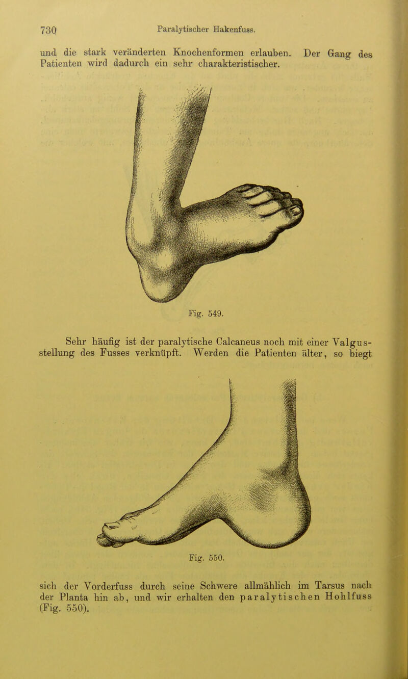 und die stark veränderten Knochenformen erlauben. Der Gang des Patienten wird dadurch ein sehr charakteristischer. Fig. 549. Sehr häufig ist der paralytische Calcaneus noch mit einer Valgus- stellung des Fusses verknüpft. Werden die Patienten älter, so biegt Fig. 550. sich der Vorderfuss durch seine Schwere allmählich im Tarsus nach der Planta hin ab, und wir erhalten den paralytischen Hohlfuss (Fig. .550).