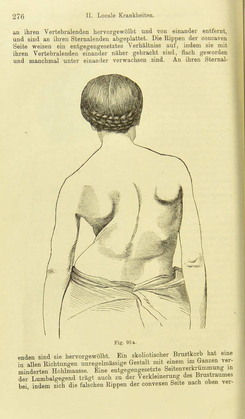 an ihren Vertebralenden hervorgewölbt und von einander entfernt, und sind an ihren Sternalenden abgeplattet. Die Rippen der concaven Seite weisen ein entgegengesetztes Verhältniss auf, indem sie mit ihren Vertebralenden einander näher gebracht sind, flach geworden und manchmal unter einander verwachsen sind. An ihren Sternal- Fig. 93 a. enden sind sie hervorgewölbt. Ein skoliotischer Brustkorb hat eme in aUen Richtungen unregehnässige Gestalt mit einem im Ganzen ver- minderten HohMaasse. Eine entgegengesetzte Seitenverkrummung m d^ Lumbaigegend trägt auch zu der Verkleinerung des Brustraumes bei iXn sich die falschen Rippen der convexen Seite nach oben ver-