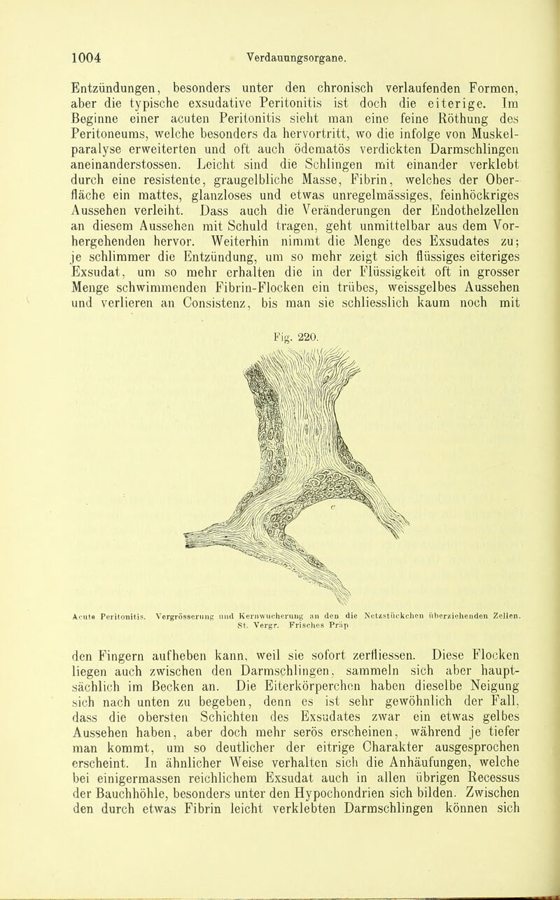 Entzündungen, besonders unter den chronisch verlaufenden Formen, aber die typische exsudative Peritonitis ist doch die eiterige. Im Beginne einer acuten Peritonitis sieht man eine feine Röthung des Peritoneums, welche besonders da hervortritt, wo die infolge von Muskel- paralyse erweiterten und oft auch ödcmatös verdickten Darmschlingen aneinanderstossen. Leicht sind die Schlingen mit einander verklebt durch eine resistente, graugelbliche Masse, Fibrin, welches der Ober- fläche ein mattes, glanzloses und etwas unregelmässiges, feinhöckriges Aussehen verleiht. Dass auch die Veränderungen der Endothelzellen an diesem Aussehen mit Schuld tragen, geht unmittelbar aus dem Vor- hergehenden hervor. Weiterhin nimmt die Menge des Exsudates zu; je schlimmer die Entzündung, um so mehr zeigt sich flüssiges eiteriges Exsudat, um so mehr erhalten die in der Flüssigkeit oft in grosser Menge schwimmenden Fibrin-Flocken ein trübes, weissgelbes Aussehen und verlieren an Consistenz, bis man sie schliesslich kaum noch mit Fig. 220. Acut« Peritonitis. Vergrössernnp; iiiul Keriiwucheruug deu die Netzstiiclicheii iiberzielieuden Zellen. St. Vergr. Frisches PrSp den Fingern aufheben kann, weil sie sofort zertliessen. Diese Flocken liegen auch zwischen den Darmschlingen, sammeln sich aber haupt- sächlich im Becken an. Die Eiterkörperchon haben dieselbe Neigung sich nach unten zu begeben, denn es ist sehr gewöhnlich der Fall, dass die obersten Schichten des Exsudates zwar ein etwas gelbes Aussehen haben, aber doch mehr serös erscheinen, während je tiefer man kommt, um so deutlicher der eitrige Charakter ausgesprochen erscheint. In ähnlicher Weise verhalten sicli die Anhäufungen, welche bei einigermassen reichlichem Exsudat auch in allen übrigen Recessus der Bauchhöhle, besonders unter den Hypochondrien sich bilden. Zwischen den durch etwas Fibrin leicht verklebten Darmschlingen können sich