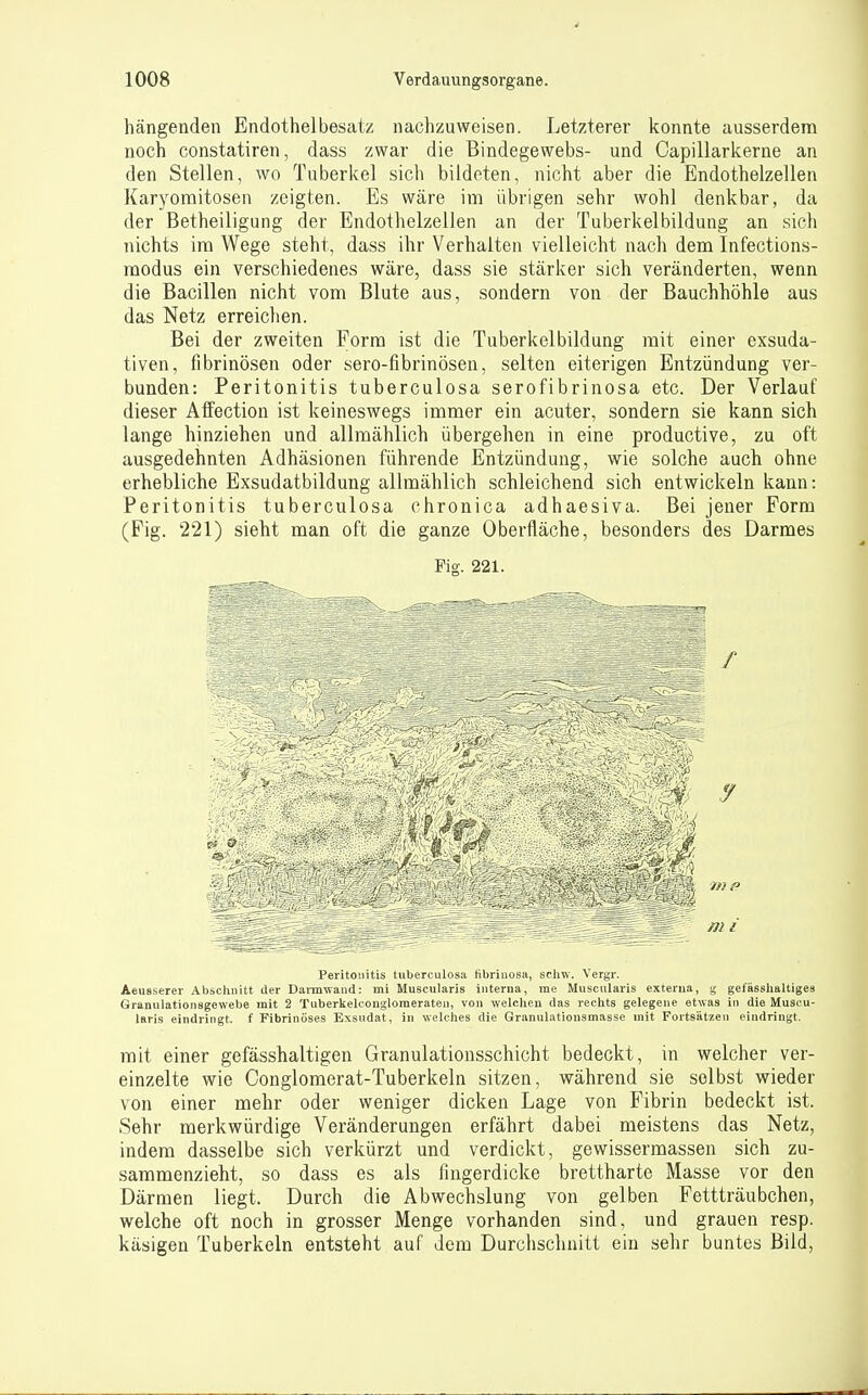 hängenden Endothelbesatz nachzuweisen. Letzterer konnte ausserdem noch constatiren, dass zwar die Bindegewebs- und Capillarkerne an den Stellen, wo Tuberkel sich bildeten, nicht aber die Endothelzellen Karyoraitosen zeigten. Es wäre im übrigen sehr wohl denkbar, da der Betheiligung der Endothelzellen an der Tuberkelbildung an .sich nichts im Wege steht, dass ihr Verhalten vielleicht nach dem Infection.s- modus ein verschiedenes wäre, dass sie stärker sich veränderten, wenn die Bacillen nicht vom Blute aus, sondern von der Bauchhöhle aus das Netz erreichen. Bei der zweiten Form ist die Tuberkelbildung mit einer exsuda- tiven, fibrinösen oder sero-fibrinösen, selten eiterigen Entzündung ver- bunden: Peritonitis tuberculosa serofibrinosa etc. Der Verlauf dieser Atiection ist keineswegs immer ein acuter, sondern sie kann sich lange hinziehen und allmählich übergehen in eine productive, zu oft ausgedehnten Adhäsionen führende Entzündung, wie solche auch ohne erhebliche Exsudatbildung allmählich schleichend sich entwickeln kann: Peritonitis tuberculosa chronica adhaesiva. Bei jeuer Form (Fig. 221) sieht man oft die ganze Oberfläche, besonders des Darmes Fig. 221. Peritonitis tuberculosa (ibriuosa, schw. Vergr. Aeusserer Abschnitt der Dannwand: mi Muscularis interna, me Muscularis externa, i; gefässlialtiges Granulationsgewebe mit 2 Tuberkelconglomeraten, von welchen das rechts gelegene etwas in die Muscu- laris eindringt, f Fibrinöses Exsudat, in welches die Granulatiousmasse mit Fortsätzen eindringt. mit einer gefässhaltigen Granulationsschicht bedeckt, in welcher ver- einzelte wie Conglomerat-Tuberkeln sitzen, während sie selbst wieder von einer mehr oder weniger dicken Lage von Fibrin bedeckt ist. Sehr merkwürdige Veränderungen erfährt dabei meistens das Netz, indem dasselbe sich verkürzt und verdickt, gewissermassen sich zu- sammenzieht, so dass es als fingerdicke brettharte Masse vor den Därmen liegt. Durch die Abwechslung von gelben Fettträubchen, welche oft noch in grosser Menge vorhanden sind, und grauen resp. käsigen Tuberkeln entsteht auf dem Durchschnitt ein sehr buntes Bild,