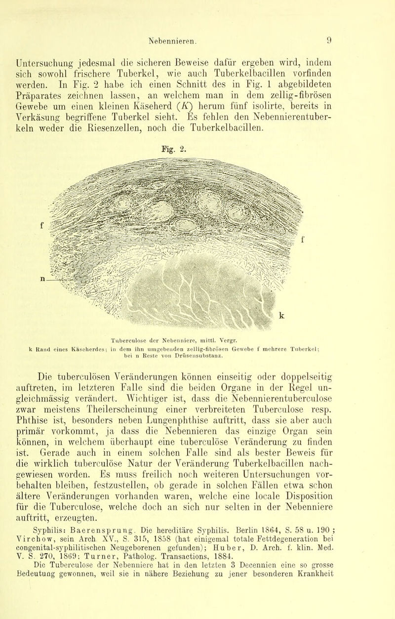 Untersuchung jedesmal die sicheren Beweise dafür ergeben wird, indem sich sowohl frischere Tuberkel, wie auch Tuberkelbacillen vorfinden werden. In Fig. 2 habe ich einen Schnitt des in Fig. 1 abgebildeten Präparates zeichnen lassen, an welchem man in dem zellig-fibrösen Gewebe um einen kleinen Käseherd (K) herum fünf isolirte, bereits in Verkäsung begriffene Tuberkel sieht. Es fehlen den Nebennierentuber- keln weder die Riesenzellen, noch die Tuberkelbacillen. Fig. 2. Tuberculose der Nebenniere, mittl. Vergr. k Rand eines Käseherdes; in dem ihn umgebenden zellig-fibrösen Gewebe f mehrere Tuberkel; bei n Reste von Drüsensubstauz. Die tuberculösen Veränderungen können einseitig oder doppelseitig auftreten, im letzteren Falle sind die beiden Organe in der Regel un- gleichmässig verändert. Wichtiger ist, dass die Nebennierentuberculose zwar meistens Theilerscheinung einer verbreiteten Tuberculose resp. Phthise ist, besonders neben Lungenphthise auftritt, dass sie aber auch primär vorkommt, ja dass die Nebennieren das einzige Organ sein können, in welchem überhaupt eine tuberculose Veränderung zu finden ist. Gerade auch in einem solchen Falle sind als bester Beweis für die wirklich tuberculose Natur der Veränderung Tuberkelbacillen nach- gewiesen worden. Es muss freilich noch weiteren Untersuchungen vor- behalten bleiben, festzustellen, ob gerade in solchen Fällen etwa schon ältere Veränderungen vorhanden waren, welche eine locale Disposition für die Tuberculose, welche doch an sich nur selten in der Nebenniere auftritt, erzeugten. Syphilis: Baerensprung. Die hereditäre Syphilis. Berlin 1864, S. 58 u. 190 ; Virchow, sein Arch. XV., S. 315, 1858 (hat einigemal totale Fettdegeneration bei congenital-syphilitischen Neugeborenen gefunden); Huber, D. Arch. f. klin. Med. V. S. 270, 1S69; Turner, Patholog. Transactions, 1884. Die Tuberculose der Nebenniere hat in den letzten 3 Decennien eine so grosse Bedeutung gewonnen, weil sie in nähere Beziehung zu jener besonderen Krankheit