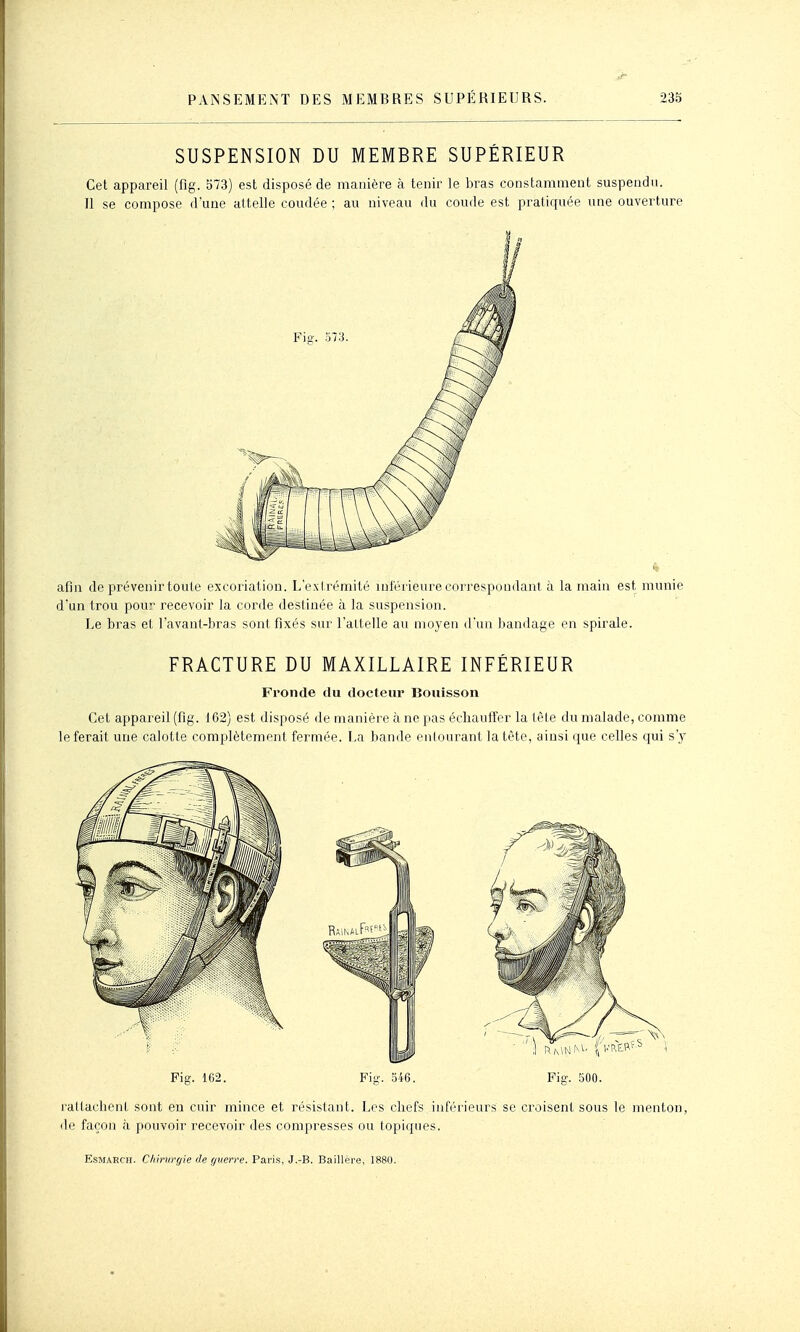 SUSPENSION DU MEMBRE SUPÉRIEUR Cet appareil (flg. 573) est disposé de manière cà tenir le bras constamment suspendu. 11 se compose d'une attelle coudée ; au niveau du coude est pratiquée une ouverture afin de prévenir toute excoriation. L'extrémité inférieure correspondant à la main est munie d'un trou pour recevoir la corde destinée à la suspension. Le bras et l'avant-bras sont fixés sur l'attelle au moyen d'un bandage en spirale. FRACTURE DU MAXILLAIRE INFERIEUR Fronde du docteur Bouisson Cet appareil (fig. 162) est disposé de manière à ne pas écliaulTer la tèle du malade, comme le ferait une calotte complètement fermée. La bande enlourant la tète, ainsi que celles qui s'y Piff. 162. Fi-. 346. Fia-. 500. radachent sont en cuir mince et résistant. Les cliefs inférieurs se croisent sous le menton, de façon à pouvoir recevoir des compresses ou topiques.