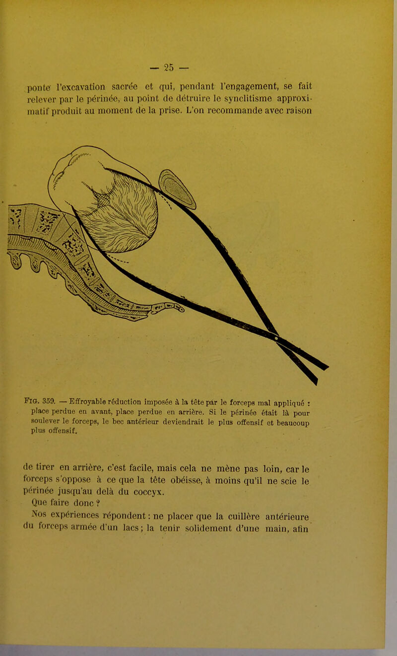 ponte l'excavation sacrée et qui, pendant l'engagement, se fait relever par le périnée, au point de détruire le synclitisme approxi- matif produit au moment de la prise. L'on recommande avec raison FiG. 359. — Effroyable réduction imposée à la tête par le forceps mal appliqué : place perdue en avant, place perdue en arrière. Si le périnée était là pour soulever le forceps, le bec antérieur deviendrait le plus offensif et beaucoup plus offensif. de tirer en arrière, c'est facile, mais cela ne mène pas loin, car le forceps s'oppose à ce que la tête obéisse, à moins qu'il ne scie le périnée jusqu'au delà du coccyx. Que faire donc ? Nos expériences répondent : ne placer que la cuillère antérieure du forceps armée d'un lacs; la tenir solidement d'une main, afin