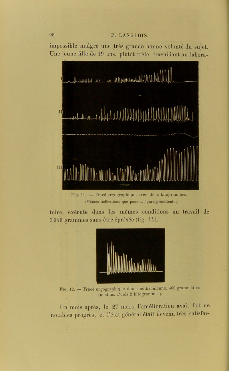 impossible malgré une très grande bonne volonté du sujet. Une jeune fille de 19 ans, plutôt frêle, travaillant au labora- Fio. IL — Tracé ergographique avec deux kilogrammes. (Mômes indications quo pour la figure prôcédento.) toire, exécute dans les mêmes conditions un travail de 3940 grammes sans être épuisée (fig 14). Fig. 12. Tracé ergographique d’une addisonicnnc. 460 grammetres (médius. Poids 2 kilogrammes). Un mois après, le 27 mars, l’amélioration avait lait de notables progrès, et l’état général était devenu très satisfai-
