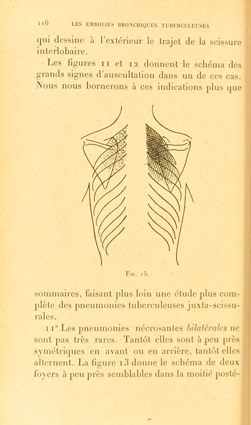 qui dessine à l’extérieur le trajet de la scissure interlobaire. Les figures 11 et 12 donnent le schéma des grands signes d auscultation dans un de ces cas. Nous nous bornerons à ces indications plus que sommaires, faisant plus loin une élude plus com- plète des pneumonies tuberculeuses juxta-scissu- rales. 1 i° Les pneumonies nécrosantes bilatérales 11c sont pas très rares. Tantôt elles sont à peu près symétriques en avant ou en arrière, tantôt elles alternent. La figure i3 donne le schéma de deux foyers à peu près semblables dans la moitié poste-