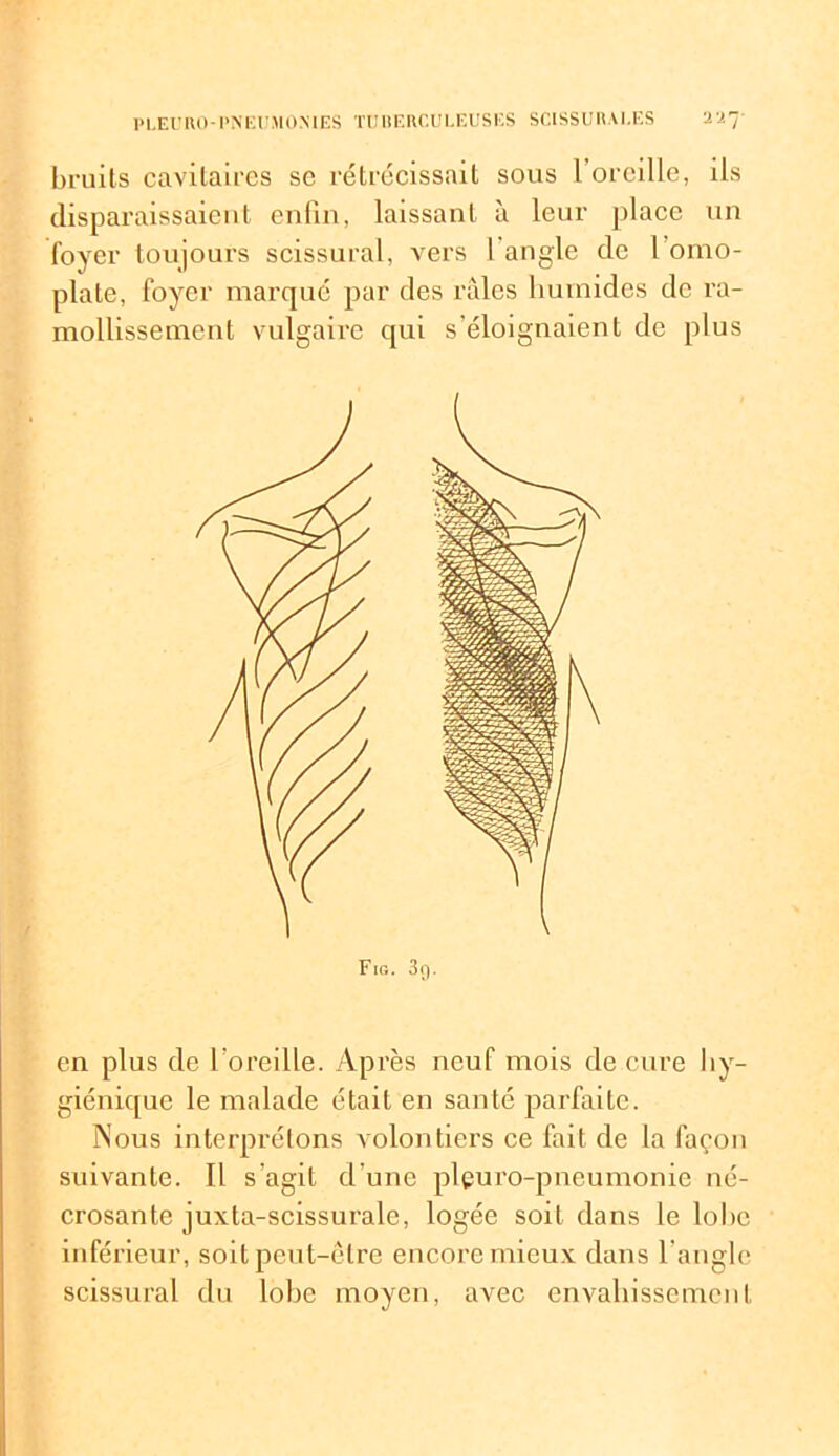 bruits cavitaires se rétrécissait sous l’oreille, ils disparaissaient enfin, laissant à leur place un foyer toujours scissural, vers 1 angle de l omo- plate, foyer marqué par des raies humides de ra- mollissement vulgaire qui s'éloignaient de plus en plus de l ’oreille. Après neuf mois de cure hy- giénique le malade était en santé parfaite. Nous interprétons volontiers ce fait de la façon suivante. Il s'agit d’une pleuro-pncumonie né- crosante juxla-scissuralc, logée soit dans le lobe inférieur, soit peut-être encore mieux dans l’angle scissural du lobe moyen, avec envahissement