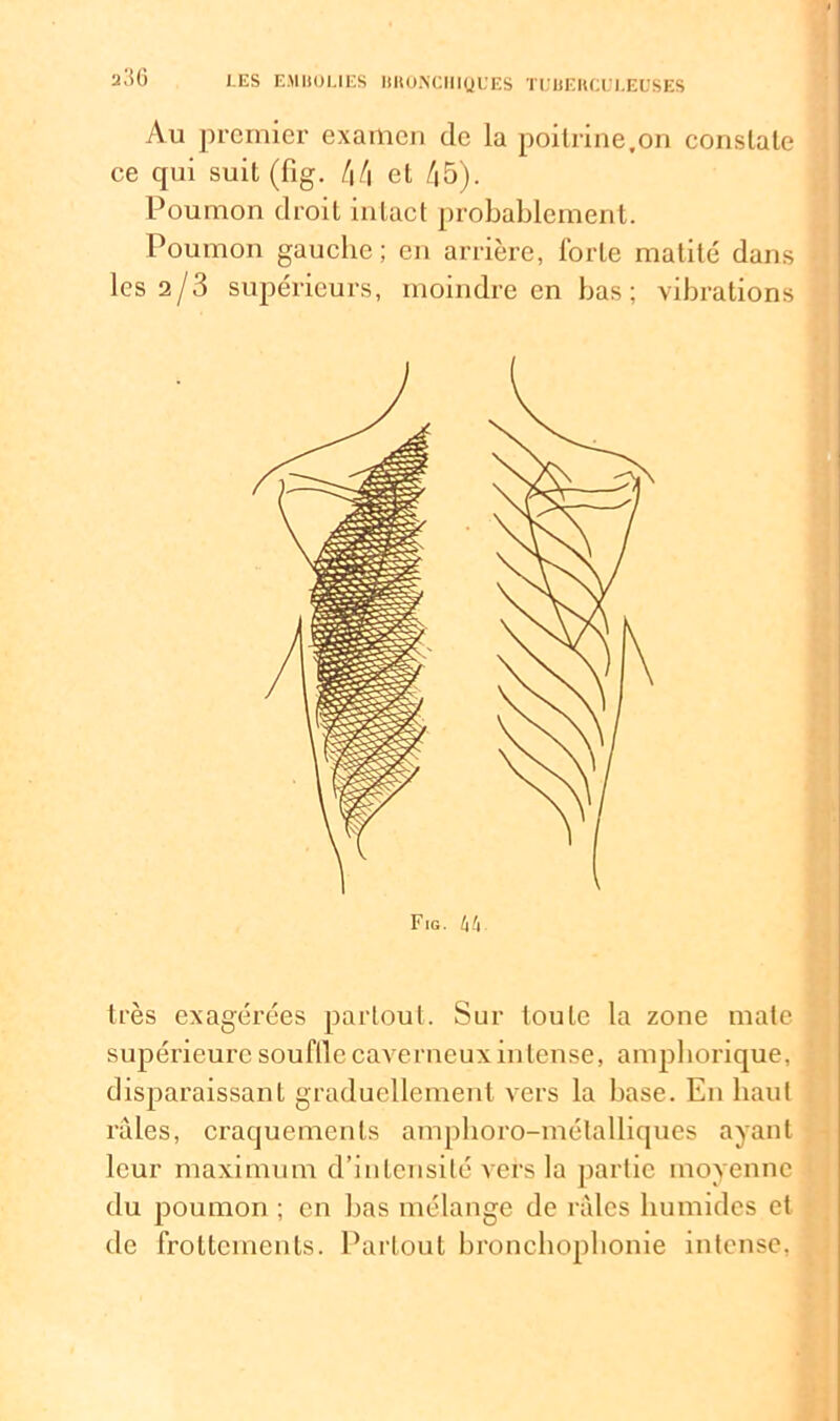 a36 Au premier examen de la poitrine,on constate ce qui suit (lig. 44 et 45). Poumon droit intact probablement. Poumon gauche ; en arrière, forte matité dans les 2/3 supérieurs, moindre en bas; vibrations très exagérées partout. Sur toute la zone mate supérieure souffle caverneux intense, amphorique, disparaissant graduellement vers la base. En haut râles, craquements amphoro-métalliques ayant leur maximum d’intensité vers la partie moyenne du poumon ; en bas mélange de râles humides et de frottements. Partout bronchophonie intense,