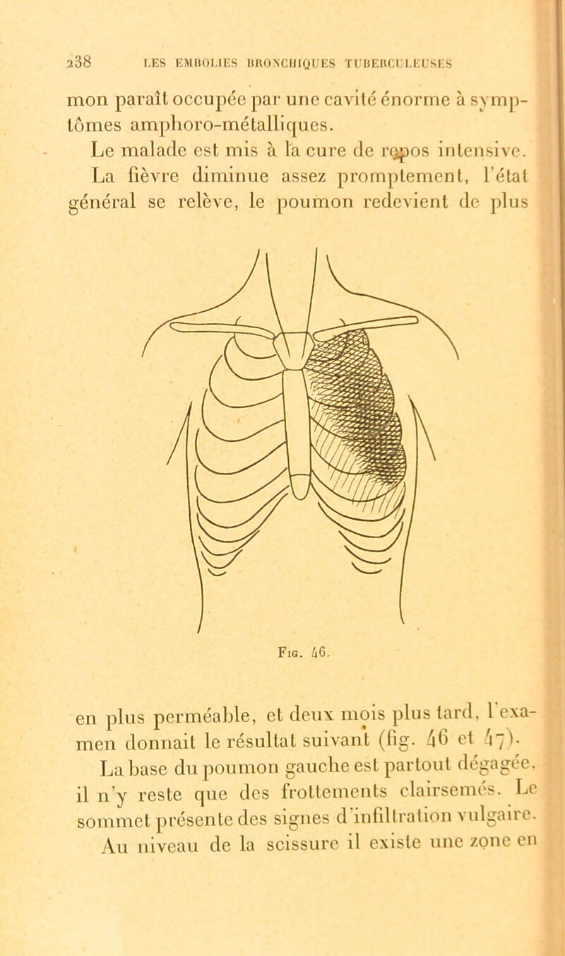 mon paraît occupée par une cavité énorme à symp- tômes amphoro-métalliques. Le malade est mis à la cure de rqpos intensive. La fièvre diminue assez promptement, l'état général se relève, le poumon redevient de plus Fig. 46. en plus perméable, et deux mois plus tard. 1 exa- men donnait le résultat suivant (fig. 4f et 4~1• La base du poumon gauebe est partout dégagée, il n’y reste cpie des frottements clairsemés. Le sommet présente des signes d infiltration vulgaire. Au niveau de la scissure il existe une zone en