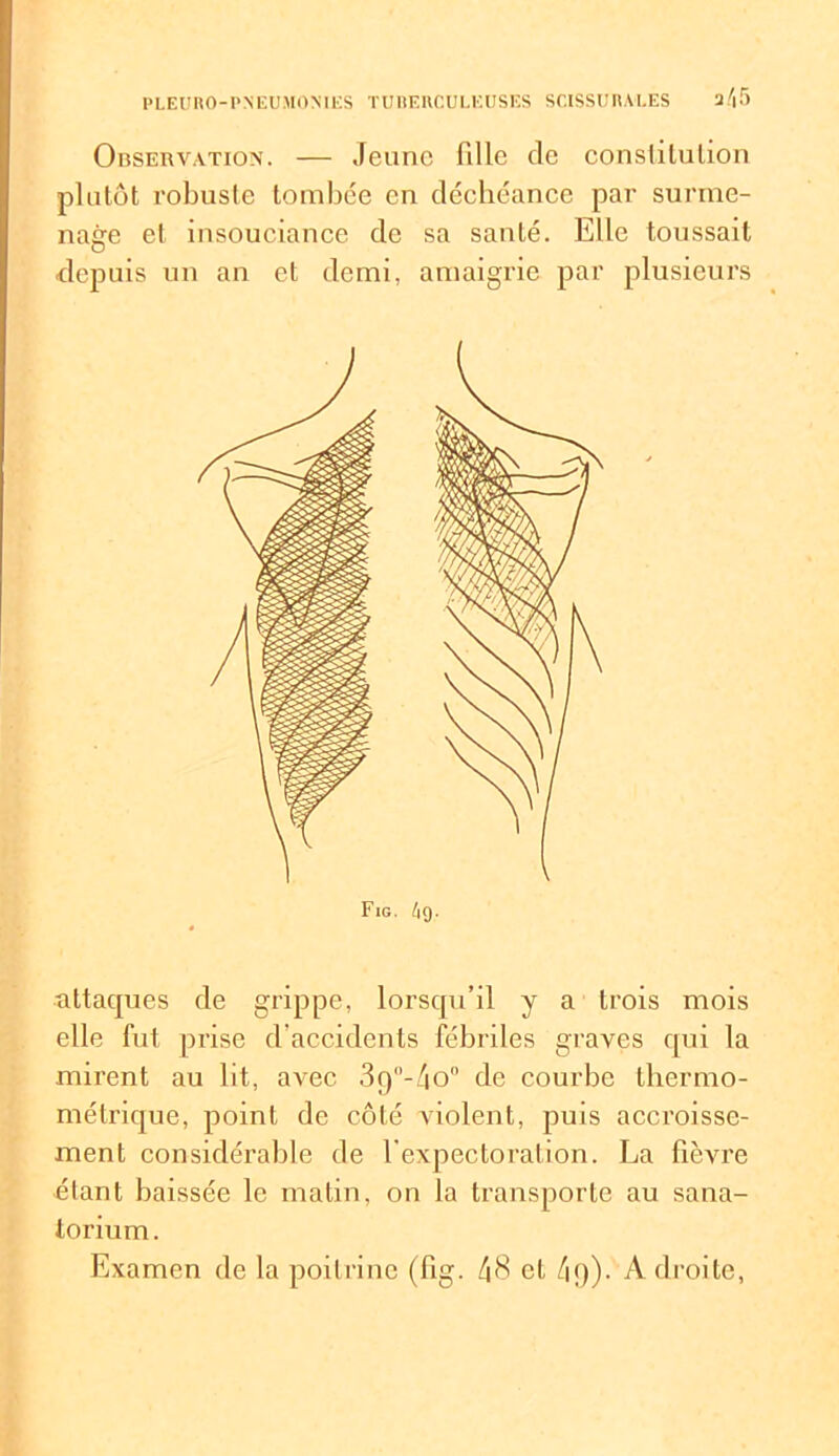 Observation. — Jeune fille de conslilulion plutôt robuste tombée en déchéance par surme- nage et insouciance de sa santé. Elle toussait -depuis un an et demi, amaigrie par plusieurs attaques de grippe, lorsqu’il y a trois mois elle fut prise d'accidents fébriles graves qui la mirent au lit, avec 3g°-/io0 de courbe thermo- métrique, point de côté violent, puis accroisse- ment considérable de l'expectoration. La fièvre étant baissée le matin, on la transporte au sana- torium . Examen de la poitrine (fig. 48 et 4<))- Adroite,