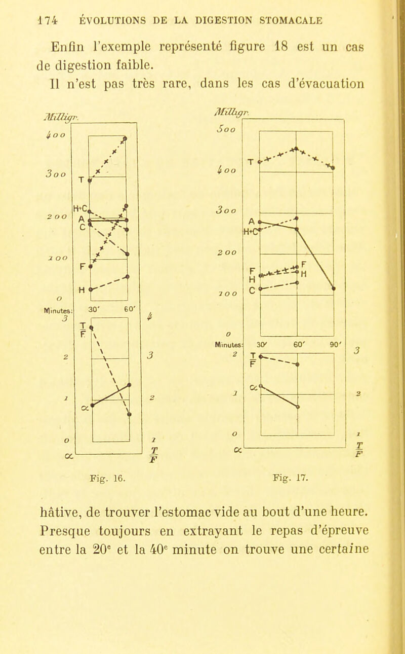 Enfin l'exemple représenté figure 18 est un cas de digestion faible. Il n'est pas très rare, dans les cas d'évacuation F Fig. 16. Fig. 17. hâtive, de trouver l'estomac vide au bout d'une heure. Presque toujours en extrayant le repas d'épreuve entre la 20' et la 40' minute on trouve une certaine