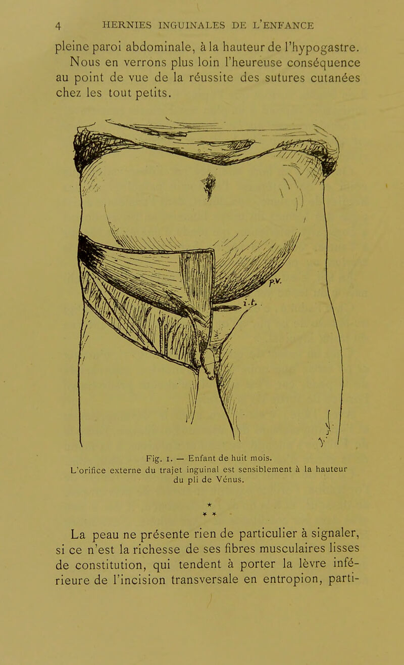 pleine paroi abdominale, à la hauteur de l'hypogastre. Nous en verrons plus loin l'heureuse conséquence au point de vue de la réussite des sutures cutanées chez les tout petits. Fig. i. — Enfant de huit mois. L'orifice externe du trajet inguinal est sensiblement à la hauteur du pli de Vénus. ★ La peau ne présente rien de particulier à signaler, si ce n'est la richesse de ses fibres musculaires lisses de constitution, qui tendent à porter la lèvre infé- rieure de l'incision transversale en entropion, parti-