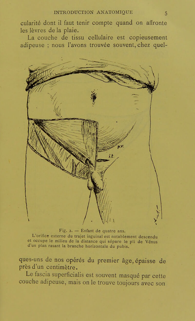 cularité dont il faut tenir compte quand on affronte les lèvres de la plaie. La couche de tissu cellulaire est copieusement adipeuse ; nous l'avons trouvée souvent, chez quel- Fig. 2. — Enfant de quatre ans. L'orifice externe du trajet inguinal est notablement descendu et occupe le milieu de la distance qui sépare le pli de Vénus d'un plan rasant la branche horizontale du pubis. ques-uns de nos opérés du premier âge, épaisse de près d'un centimètre. Le fascia superficialis est souvent masqué par cette couche adipeuse, mais on le trouve toujours avec son