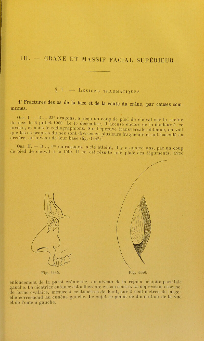 m. - CRANE ET MASSIF FACIAL SUPÉRIEUR 1 Lésions tuaumatiques 1 Fractures des os de la face et de la voûte du crâne, par causes com- munes. Obs. I — D. 23« dragons, a reçu un coup de pied de cheval sur la racine du nez, le 6 juillet 1900. Le la décembre, il accuse encore de la douleur à ce niveau, et nous le radiographions. Sur l'épreuve traasversale obtenue, on voit que les os propres du nez sont divisés en plusieurs fragments et ont basculé en arrière, au niveau de leur base (fig.H45). Obs. II. — D..., l^' cuirassiers, a été atteint, il y a quatre ans, par un coup de pied de cheval a la tète. Il en est résulté une plaie des téguments, avec Fig. 1145. Fis. 1146. enfoncement de la paroi crânienne, au niveau de la région occipito-parictale gauche. La cicatrice cutanée est adhérente en son centre. La dépression osseuse, de forme ovalaire, mesure 4 centimètres de haut, sur 2 centimètres de large; elle correspond au cunéus gauche. Le sujet se plaint de diminution de la vue et de l'ouïe à gauche.