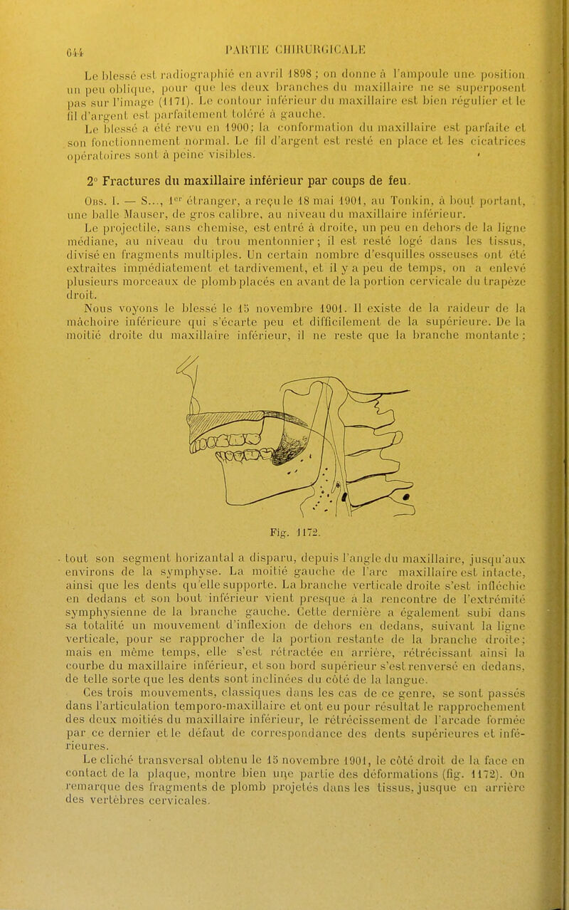 Le I)lessé esL radiog'raphié on avril 1898 ; on donne; à l'ampoule une position un peu oblique, pour que les deux hranclies du maxillaire ne se sup(;i'|)osenl pas sur l'image (1171). Le conlour inl'éi'ieui- du maxillaii'c csl bien rcg-ulio- et le 01 d'argent est parfaitement toléré à gauche. Le blessé a été l'evu en 1900: la conformalion du maxillaire est parfaite et son fonctionnement noi'uial. Le (il d'argent est l'csté en place et les cicatrices opératoires sont à peine visibles. 2° Fractures du maxillaire inférieur par coups de feu. 0ns. 1. — S..., 1*-''' étrangei', a reçu le 18 mai 1901, au Tonkin, à bout portant, une balle Mauser, de gros calibre, au niveau du maxillaire inférieur. Le projectile, sans chemise, est entré à droite, un peu en dehors de la ligne médiane, au niveau du trou mentonnier; il est resté logé dans les tissus, divisé en fragments multiples. Un certain nombre d'esquilles osseuses ont été extraites immédiatement et tardivement, et il y a peu de temps, on a enlevé plusieurs morceaux de plomb placés en avant de la portion cervicale du trapèze droit. Nous voyons le blessé le Ib novembre 1901. 11 existe de la raideur de la mâchoire inférieure qui s'écarte peu et difficilement de la supérieure. De la moitié droite du maxillaire inférieur, il ne reste que la branche montante : tout son segment horizantal a disparu, depuis l'angle du maxillaire, jusqu'aux environs de la symphyse. La moitié gauche de l'arc maxillaire est intacte, ainsi que les dents qu'elle supporte. La branche verticale droite s'est infléchie en dedans et son bout inférieur vient presque a la rencontre de l'extrémité symphysienne de la branche gauche. Cette dernière a également subi dans sa totalité un mouvement d'inflexion de dehoi-s en dedans, suivant la ligne verticale, pour se rapprocher de la portion restante de la branche droite; mais en même temps, elle s'est rétractée en arrière, rétrécissant ainsi la courbe du maxillaire inférieur, et son bord supérieur s'est renversé en dedans, de telle sorte que les dents sont inclinées du côté de la langue. Ces trois mouvements, classiques dans les cas de ce genre, se sont passés dans l'articulation temporo-maxillaire et ont eu pour résultat le rapprochement des deux moitiés du maxillaire inférieur, le rétrécissement de l'arcade formée par ce dernier elle défaut de correspondance des dents supérieures et infé- rieures. Le cliché transversal obtenu le 15 novembre 1901, le côté droit de la face en contact de la plaque, montre bien ui^c partie des déformations (fig. 1172). On remarque des fragments de plomb projetés dans les tissus, jusque en arrière des vertèbres cervicales.