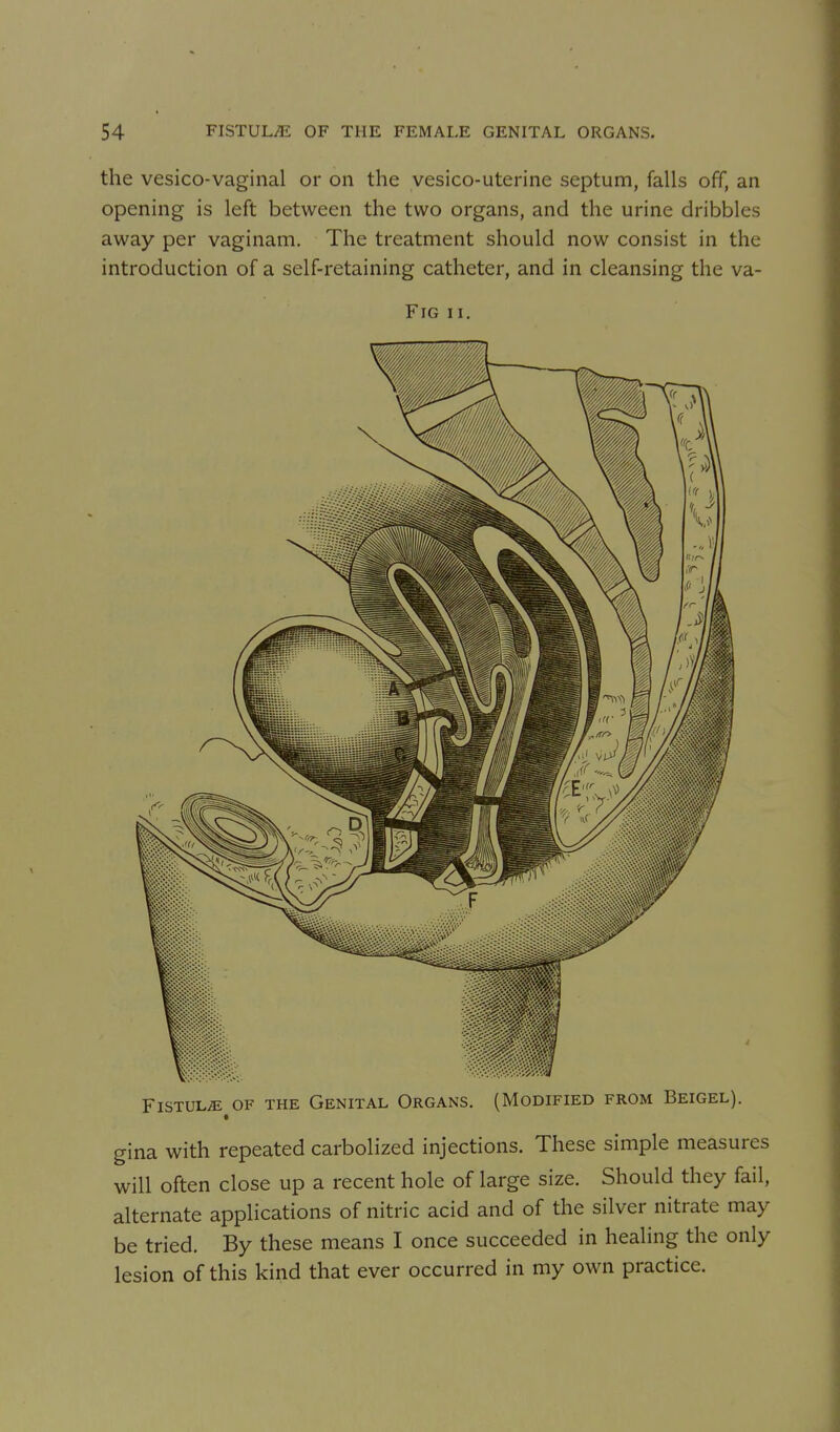 the vesico-vaginal or on the yesico-uterine septum, falls off, an opening is left between the two organs, and the urine dribbles away per vaginam. The treatment should now consist in the introduction of a self-retaining catheter, and in cleansing the va- FlG II. FiSTULiE OF THE GeNITAL ORGANS. (MODIFIED FROM BEIGEL). gina with repeated carbolized injections. These simple measures will often close up a recent hole of large size. Should they fail, alternate applications of nitric acid and of the silver nitrate may be tried. By these means I once succeeded in healing the only lesion of this kind that ever occurred in my own practice.