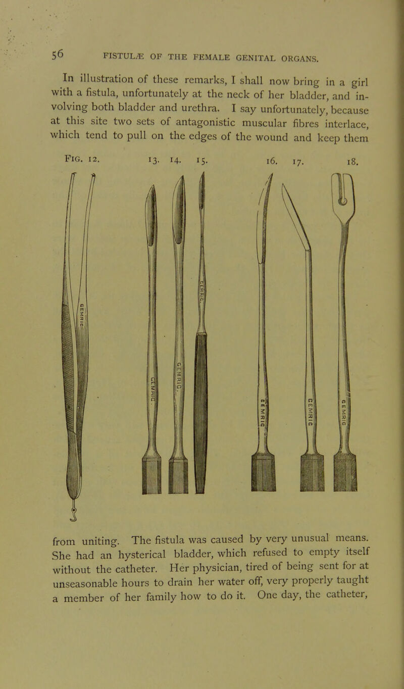 In illustration of these remarks, I shall now bring in a girl with a fistula, unfortunately at the neck of her bladder, and in- volving both bladder and urethra. I say unfortunately, because at this site two sets of antagonistic muscular fibres interlace, which tend to pull on the edges of the wound and keep them from uniting. The fistula was caused by very unusual means. She had an hysterical bladder, which refused to empty itself without the catheter. Her physician, tired of being sent for at unseasonable hours to drain her water off, very properly taught a member of her family how to do it. One day, the catheter.