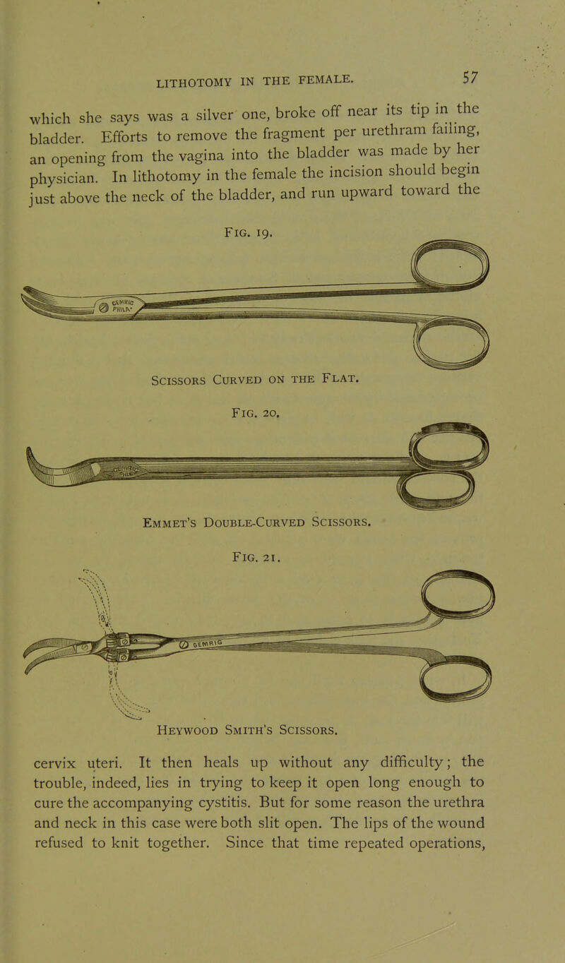 LITHOTOMY IN THE FEMALE. which she says was a silver one, broke off near its tip in the bladder Efforts to remove the fragment per urethram failing, an opening from the vagina into the bladder was made by her physician. In lithotomy in the female the incision should begin just above the neck of the bladder, and run upward toward the Fig. 19 Scissors Curved on the Flat. Fig. 20. Emmet's Double-Curved Scissors. Fig. 21. Heywood Smith's Scissors. cervix uteri. It then heals up without any difficulty; the trouble, indeed, lies in trying to keep it open long enough to cure the accompanying cystitis. But for some reason the urethra and neck in this case were both slit open. The lips of the wound refused to knit together. Since that time repeated operations,
