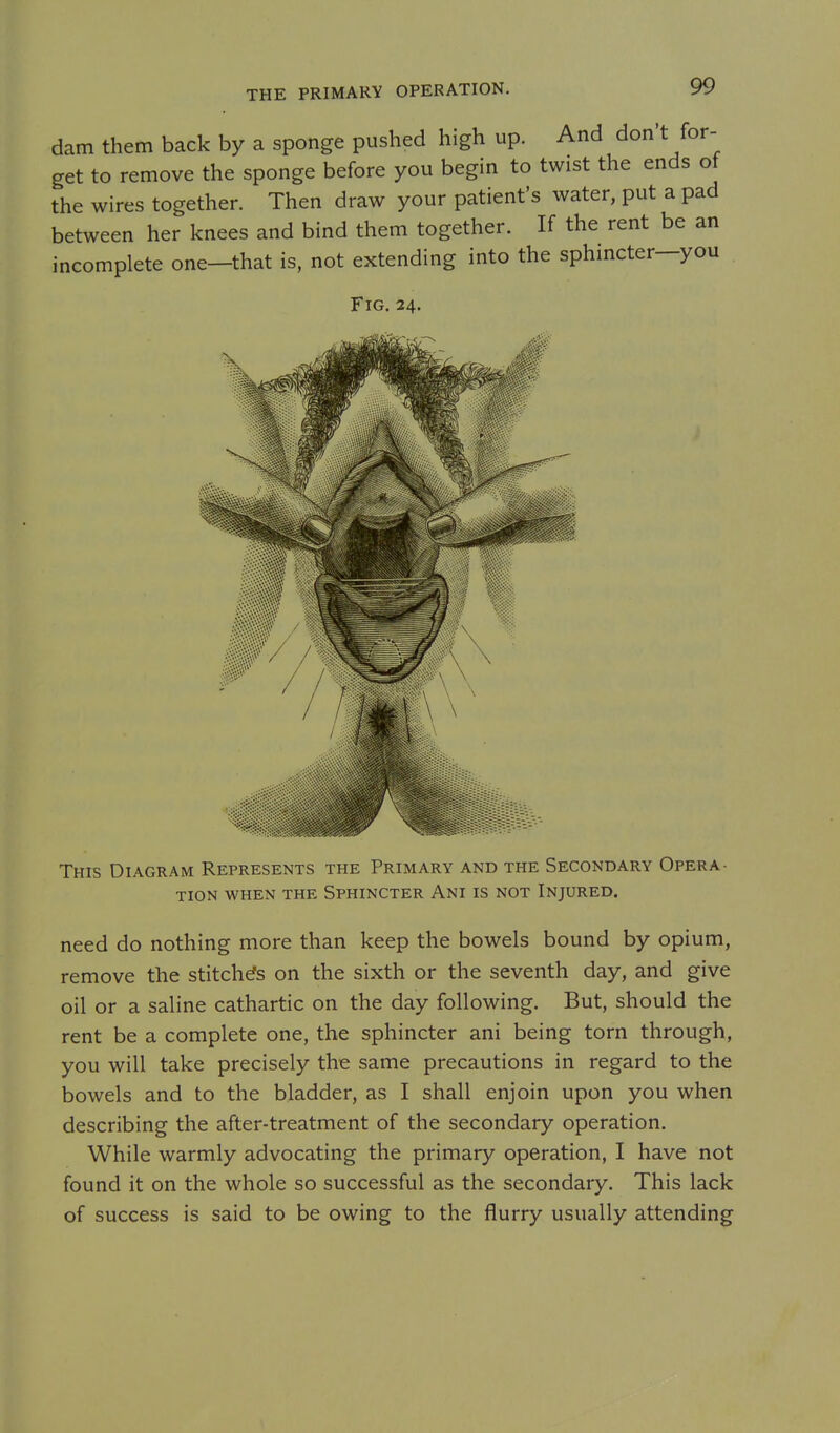 dam them back by a sponge pushed high up. And don t for- get to remove the sponge before you begin to twist the ends ot the wires together. Then draw your patient's water, put a pad between her knees and bind them together. If the rent be an incomplete one—that is, not extending into the sphincter—you Fig. 24. This Diagram Represents the Primary and the Secondary Opera- tion WHEN the Sphincter Ani is not Injured. need do nothing more than keep the bowels bound by opium, remove the stitches on the sixth or the seventh day, and give oil or a saline cathartic on the day following. But, should the rent be a complete one, the sphincter ani being torn through, you will take precisely the same precautions in regard to the bowels and to the bladder, as I shall enjoin upon you when describing the after-treatment of the secondary operation. While warmly advocating the primary operation, I have not found it on the whole so successful as the secondary. This lack of success is said to be owing to the flurry usually attending