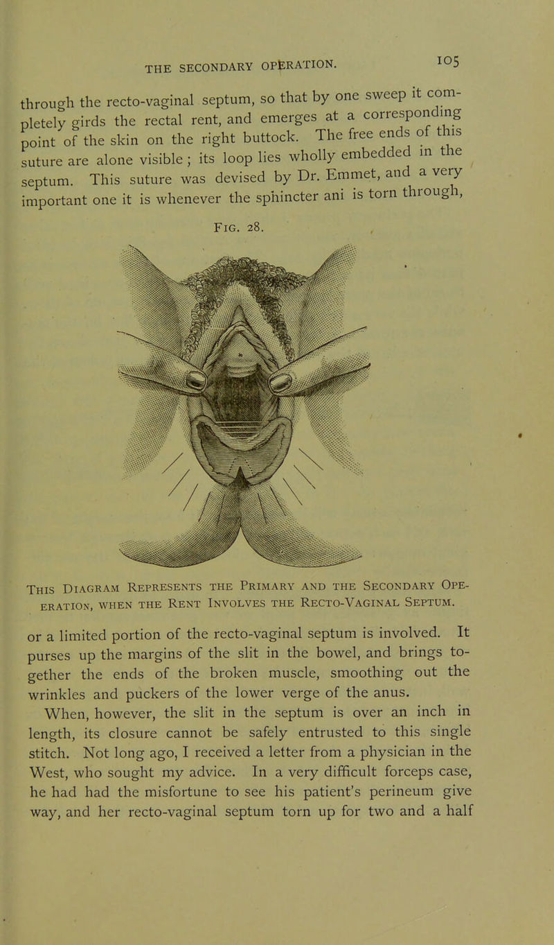through the recto-vaginal septum, so that by one sweep it com- pletely girds the rectal rent, and emerges at a corresponding point of the skin on the right buttock. The free ends of this suture are alone visible; its loop lies wholly embedded in the septum. This suture was devised by Dr. Emmet, and a very important one it is whenever the sphincter ani is torn through, Fig. 28. This Diagram Represents the Primary and the Secondary Ope- ERATION, when THE RENT INVOLVES THE ReCTO-VAGINAL SEPTUM. or a limited portion of the recto-vaginal septum is involved. It purses up the margins of the slit in the bowel, and brings to- gether the ends of the broken muscle, smoothing out the wrinkles and puckers of the lower verge of the anus. When, however, the slit in the septum is over an inch in length, its closure cannot be safely entrusted to this single stitch. Not long ago, I received a letter from a physician in the West, who sought my advice. In a very difficult forceps case, he had had the misfortune to see his patient's perineum give way, and her recto-vaginal septum torn up for two and a half