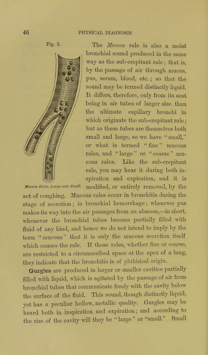 ^S- 5. The BIucous rale is also a moist broncliial sound produced in the same way as the sub-crepitant rale ; that is, by the passage of air through mucus, pus, serum, blood, etc. ; so that the sound may be termed distinctly hqtiid. It differs, therefore, only from its seat being in air tubes of larger size than the ultimate capillary bronchi in which originate the sub-crepitant rale; but as these tubes are themselves both small and large, so we have  smaU, or what is termed  fine mucous rales, and  large  or  coarse  mu- cous rales. Like the sub-crepitant rale, you may hear it during both in- spiration and expiration, and it is Mucous Rales, Large and Small, modified, or entirely rcmoved, by the act of coughing. Mucous rales occur iu bronchitis during the stage of secretion; in bronchial hemorrhage; whenever pus makes its way into the air passages from an abscess,—^in short, whenever the bronchial tubes become partially filled with fluid of any kind, and hence we do not intend to imply by the term mucous that it is only the mucous secretion itseK which causes the rale. If these rales, whether fine or coarse, are restricted to a circumscribed space at the apex of a lung, they indicate that the bronchitis is of phthisical origin. Gvirgles are produced in larger or smaller cavities partially filled with liquid, which is agitated by the passage of air fi'om bronchial tubes that communicate freely with the cavity below the surface of the fluid. This sound, though distinctly liquid, yet has a peculiar hollow, metallic quahty. Gurgles may be heard both in inspiration and expiration; and according to the size of the cavity will they be  large  or small. Small