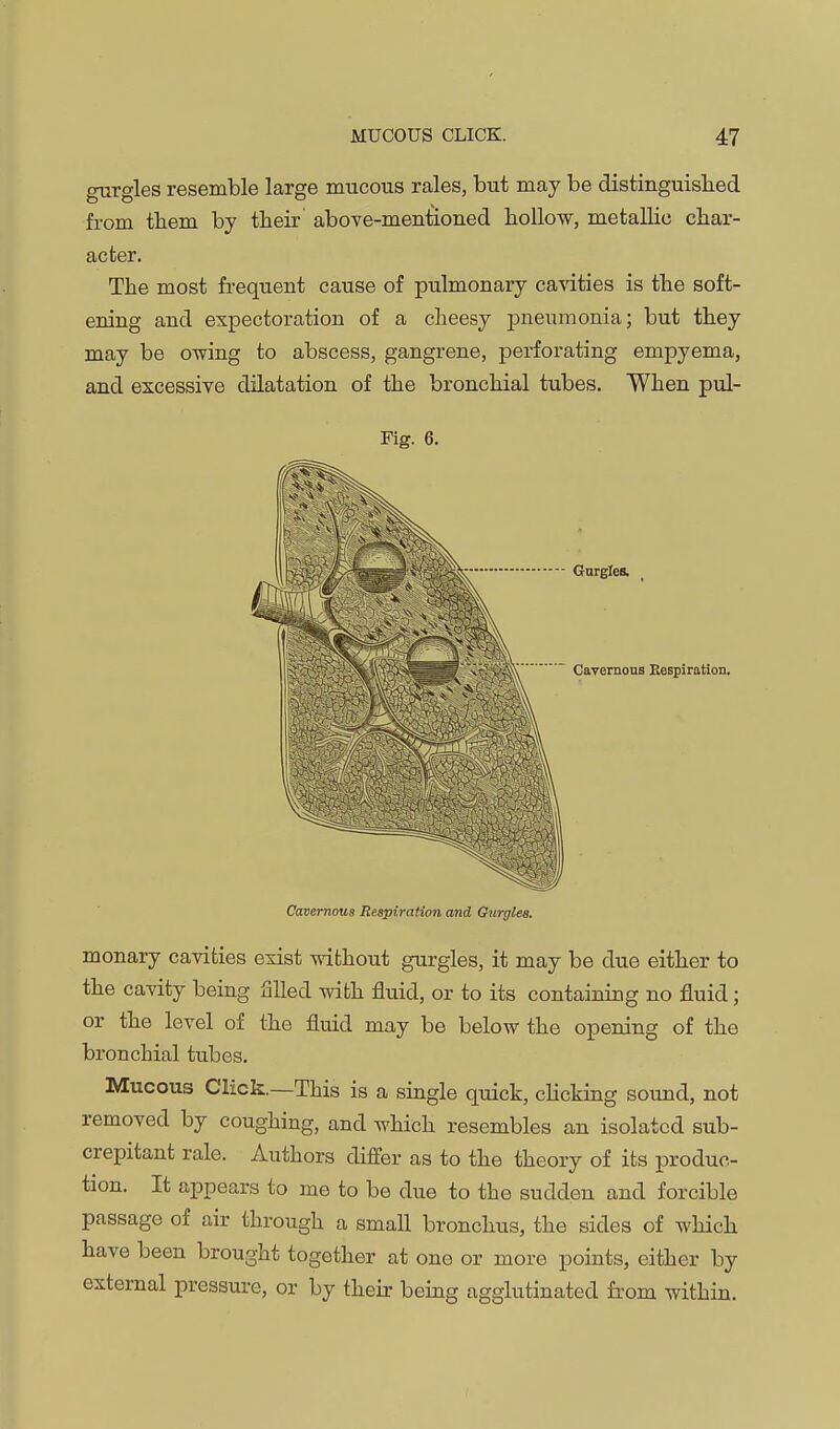 gurgles resemble large mucous rales, but may be distinguished from them by their aboTe-mentioned hollow, metaUio char- acter. The most frequent cause of pulmonary ca-vities is the soft- ening and expectoration of a cheesy pneumonia; but they may be owing to abscess, gangrene, perforating empyema, and excessive dilatation of the bronchial tubes. When pul- Fig. 6. Gurgles. Cavernous Bespiration. Cavernous Respiration and Chirgles. monary cavities exist without gurgles, it may be due either to the cavity being Slled with fluid, or to its containing no fluid; or the level of the fluid may be below the opening of the bronchial tubes. Mucous Click.—This is a single quick, chcking sound, not removed by coughing, and which resembles an isolated sub- crepitant rale. Authors differ as to the theory of its produc- tion. It appears to me to be due to the sudden and forcible passage of air through a small bronchus, the sides of which have been brought together at one or more points, either by external pressure, or by their being agglutinated fi'om within.