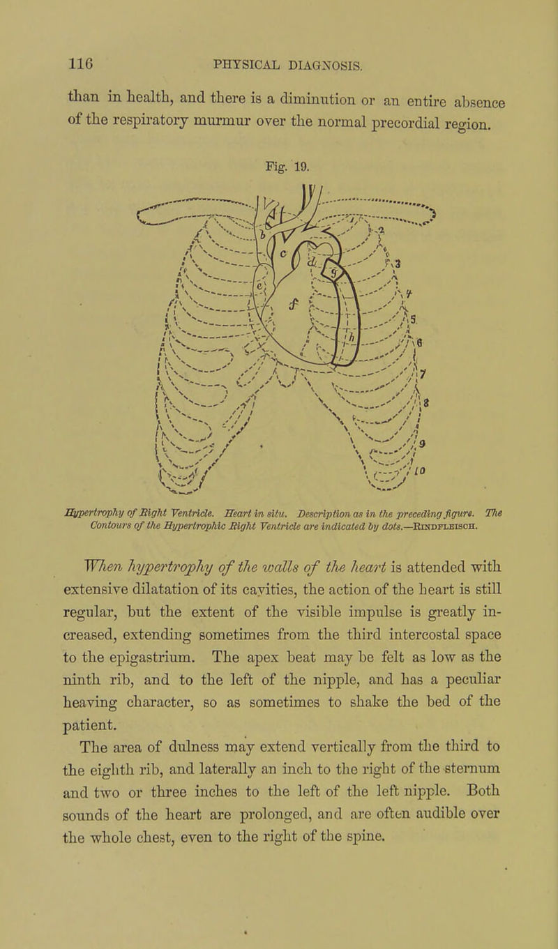 tlian in health, and there is a diminution or an entire absence of the respiratory murmur over the normal precordial reo-ion. Fig. 19. Bupertrophy of Right Ventride. Heart in situ. Description as in the preceding figure. The Contours of the Hypertrophic Might Ventricle are indicated by doi*.—EmDixEisoH. W/ien hi/pertrqphy of the walls of tJie heart is attended with extensive dilatation of its cavities, the action of the heart is still regular, but the extent of the visible impulse is gi'eatly in- creased, extending sometimes from the third intercostal space to the epigastrium. The apex beat may be felt as low as the ninth rib, and to the left of the nipple, and has a peculiar heaving character, so as sometimes to shake the bed of the patient. The area of dulness may extend vertically from the third to the eighth rib, and laterally an inch to the right of the steramn and two or three inches to the left of the left nipple. Both sounds of the heart are prolonged, and are often audible over the whole chest, even to the right of the spine.