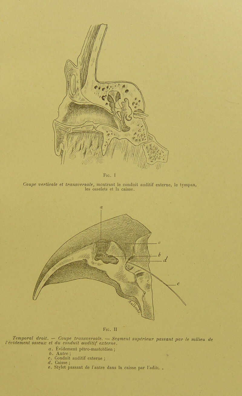 FlG. I Coupe verticale et transversale, montrant le conduit auditif externe, le tympun, les osselets et la caisse. a Fie. II Temporal droit. — Coupe transversale. — Set/ment supérieur passant par le milieu de t'évidement osseux et du conduit auditif externe. a. Évidement pélro-mastoïdien ; b. Antre ; ^ c. Conduit auditif externe ; d. Caisse ; e. Stylet passant de l'antre dans la caisse par l'aditi. .