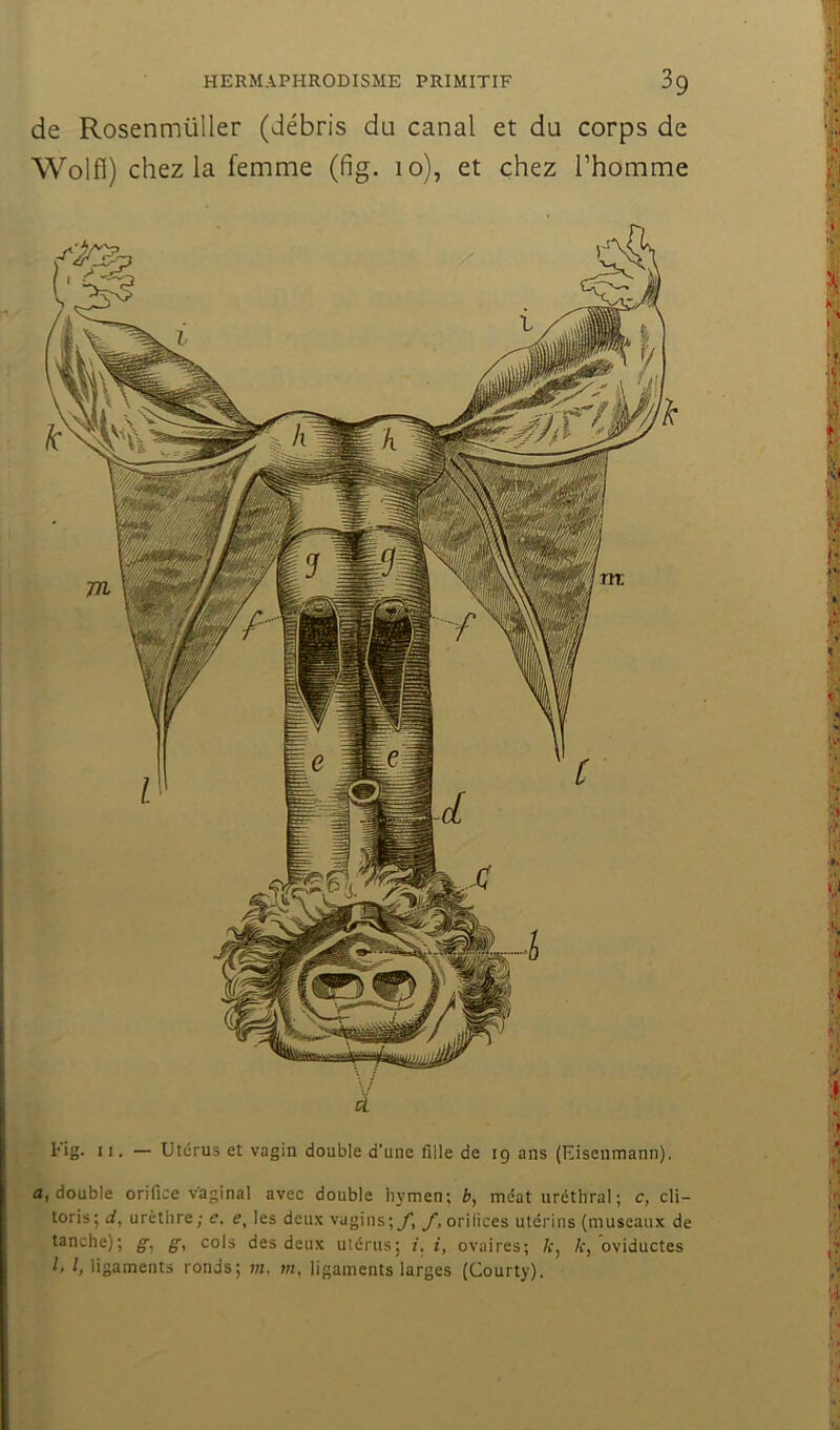 HERMAPHRODISME PRIMITIF 3 g de Rosenmüller (débris du canal et du corps de Wolfl) chez la femme (fig. lo), et chez Thomme à Kig. II. — Utérus et vagin double d’une fille de 19 ans (Eisenmann). a, double orifice v’aginal avec double hymen; b, méat uréthral; c, cli- toris; d, urèthre; e, e, les deux vagins-jy, y orifices utérins (museaux de tanche); g, g, cols des deux utérus; i. i, ovaires; /c, k, oviductes ligaments ronds; m, m, ligaments larges (Courty).