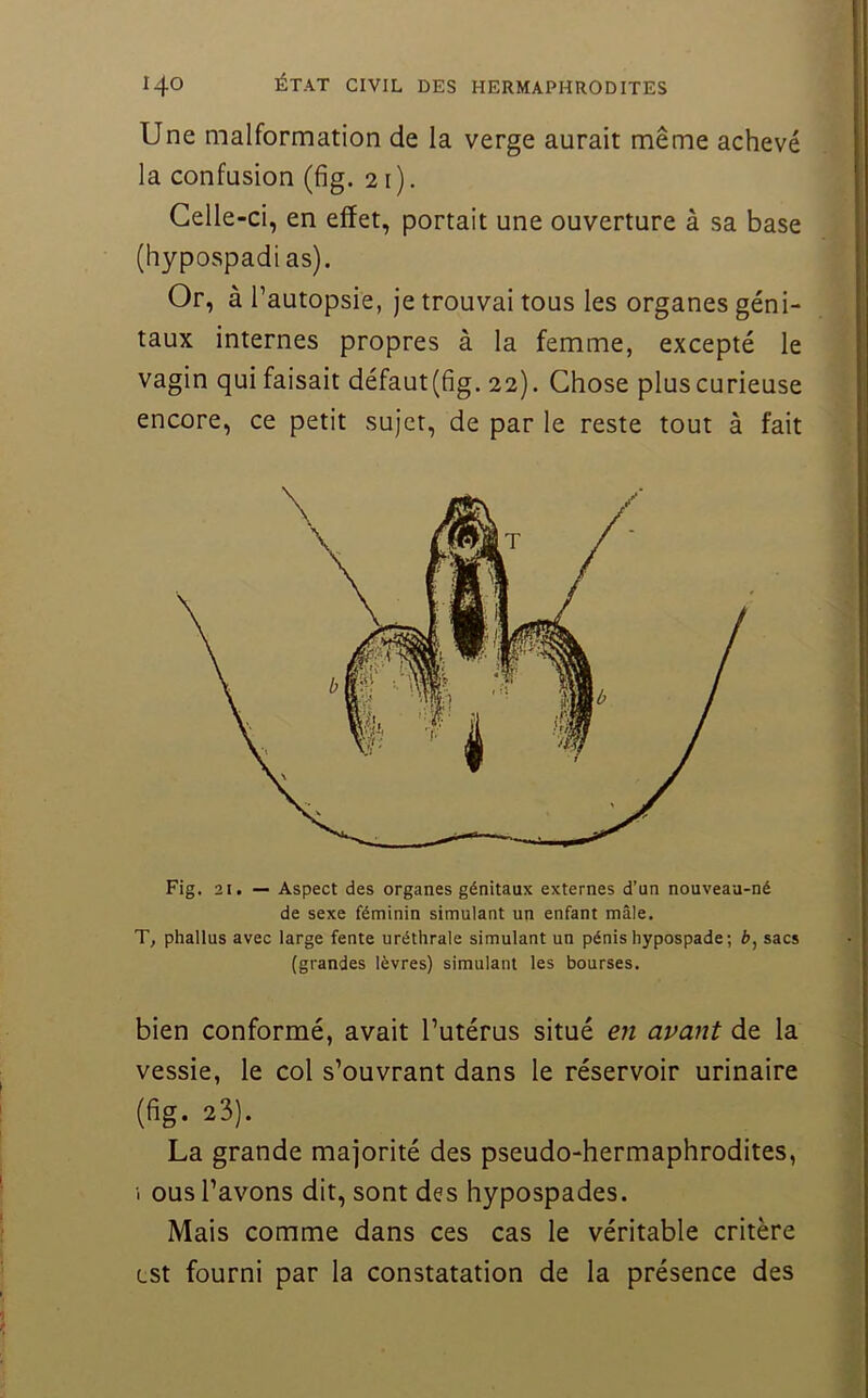 Une malformation de la verge aurait même achevé la confusion (fig. 21). Celle-ci, en effet, portait une ouverture à sa base (hypospadias). Or, à l’autopsie, je trouvai tous les organes géni- taux internes propres à la femme, excepté le vagin qui faisait défaut(fig. 22). Chose plus curieuse encore, ce petit sujet, de par le reste tout à fait Fig. 21. — Aspect des organes génitaux externes d’un nouveau-né de sexe féminin simulant un enfant mâle. T, phallus avec large fente uréthrale simulant un pénis hypospade; sacs (grandes lèvres) simulant les bourses. bien conformé, avait l’utérus situé en avant de la vessie, le col s’ouvrant dans le réservoir urinaire (fig. 23). La grande majorité des pseudo-hermaphrodites, i ous l’avons dit, sont des hypospades. Mais comme dans ces cas le véritable critère est fourni par la constatation de la présence des