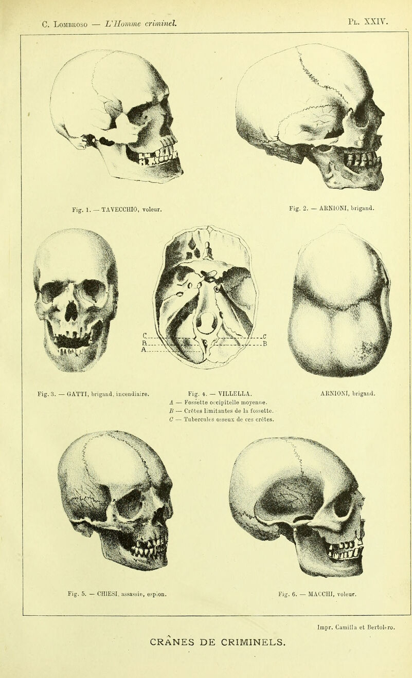 Vu XXIV. Fig. 3. — GATÏI, brigand, lucendiaire. Fig. i. — VILLELLA. ARNIONI, brigand. A — Fossette oucipitelle moyenne. B ■— Crêtes limitantes de la fossette. 0 — Tubercules osseux de ces crêtes. Fig. 5. — CHIESI, assassin, espion. Fig. 6. — MACCHI, voleur. Impr. Camilla et Bertoltro.