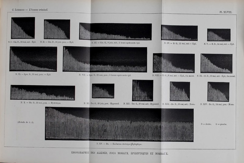 Pl. XLvm. N.I. - Gia. P.. 16 niai, aot. - Êpil. X. 11. — Gia. 1» , 10 juin, |ioiii. — Epil. j^ljjjjjyjlll^^ iSMIHHlHliyukiniii X. VI. — Sper. i>., lu uiai, poiii. — £pil. N. VII. — Sper. D., 29 mai, poni.j 5 heures après accès ôpil. N. VIII. — Cl. G., 8 mai, ant. — Épil., fou moral. N. IX. - Cl. D., 12 mai, ant. - Épil., fou moral. i .li, l'oni. — Hvîti.'Tipjue. K. XI.■ Ter. G., 30 juin, pom. - Hypocond. N. XII. - Ter. G-, 20 mai, ant. - Hypocond. , K. XIII. - Ro. D., IG mai, ant, • Norm. K. XIV. • Ko. G., U mai, pom. - Norm. (Echelle âe 2 :3). D = droite ; G = gauche. ERtiOWKAPHlE DES ALIÉNÉS, FOUS MOKAUX, ÉPILEPTIQtJBS ET NOBMAUX.