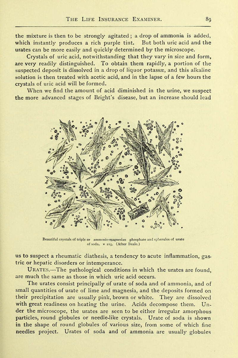 the mixture is then to be strongly agitated ; a drop of ammonia is added, which instantly produces a rich purple tint. But both uric acid and the urates can be more easily and quickly determined by the microscope. Crystals of uric acid, notwithstanding that they vary in size and form, are very readily distinguished. To obtain them rapidly, a portion of the suspected deposit is dissolved in a drop of liquor potassjE, and this alkaline solution is then treated with acetic acid, and in the lapse of a few hours the crystals of uric acid will be formed. When we find the amount of acid diminished in the urine, we suspect the more advanced stages of Bright's disease, but an increase should lead Beautiful crystals of triple or ammonio-njagnesian phosphate and spherules of urate of soda. X 215. (After Beale.) US to suspect a rheumatic diathesis, a tendency to acute inflammation, gas- tric or hepatic disorders or intemperance. Urates.—The pathological conditions in which the urates are found, are much the same as those in which uric acid occurs. The urates consist principally of urate of soda and of ammonia, and of small quantities of urate of lime and magnesia, and the deposits formed on their precipitation are usually pink, brown or white. They are dissolved with great readiness on heating the urine. Acids decompose them. Un- der the microscope, the urates are seen to be either irregular amorphous particles, round globules or needle-like crystals. Urate of soda is shown in the shape of round globules of various size, from some of which fine needles project. Urates of soda and of ammonia are usually globules