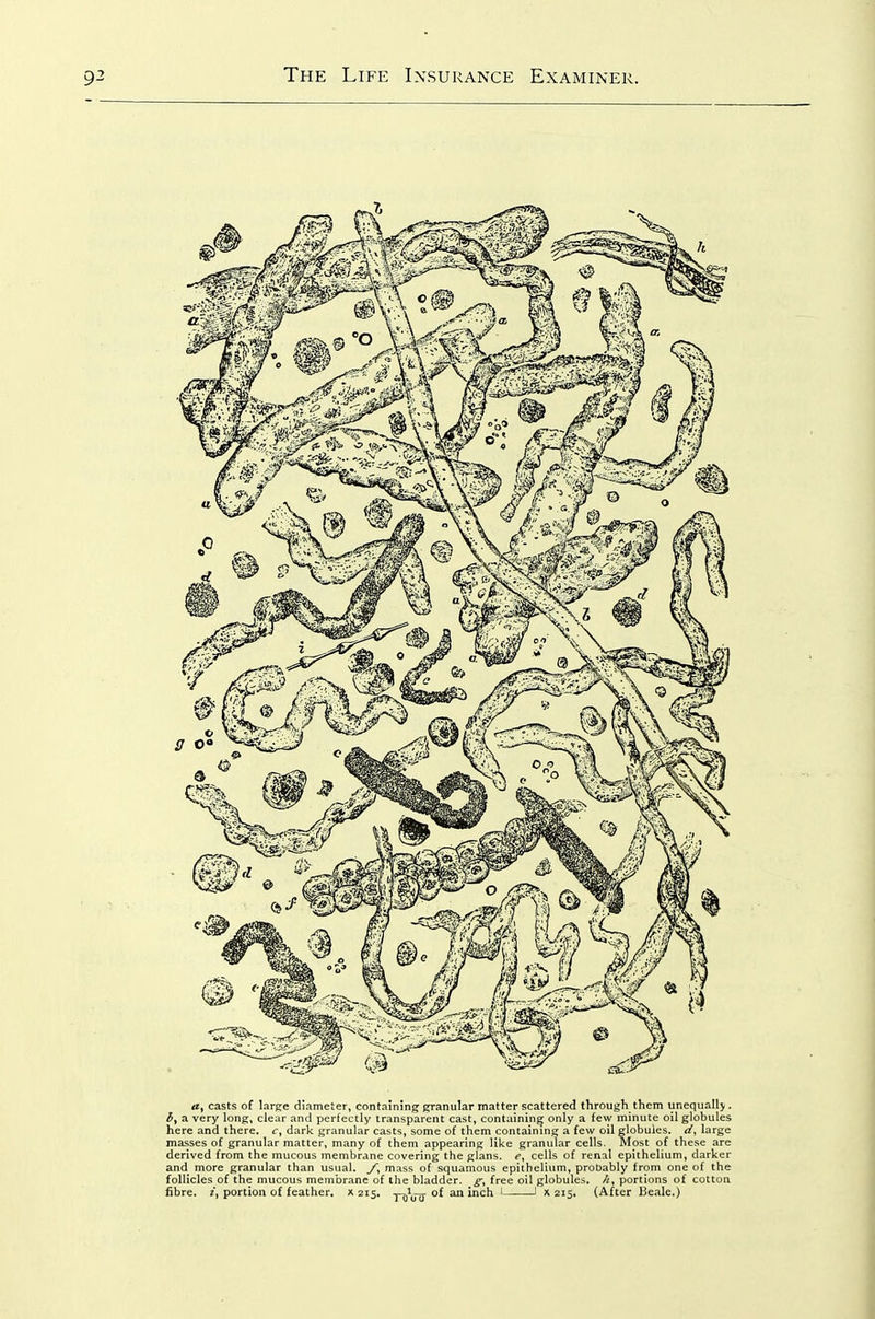 a, casts of large diameter, containing granular matter scattered through them unequally. i, a very long, clear and perfectly transparent cast, containing only a few minute oil globules here and there, c, dark granular casts, some of them containing a few oil globules, d, large masses of granular matter, many of them appearing like granular cells. Most of these are derived from the mucous membrane covering the glans. f, cells of renal epithelium, darker and more granular than usual, y, mass of squamous epithelium, probably from one of the follicles of the mucous membrane of the bladder. ^, free oil globules, /i, portions of cotton fibre. portion of feather, x 215. -r-^uiS °^ ^ lach. 1 1 x 215. (After Beale.)