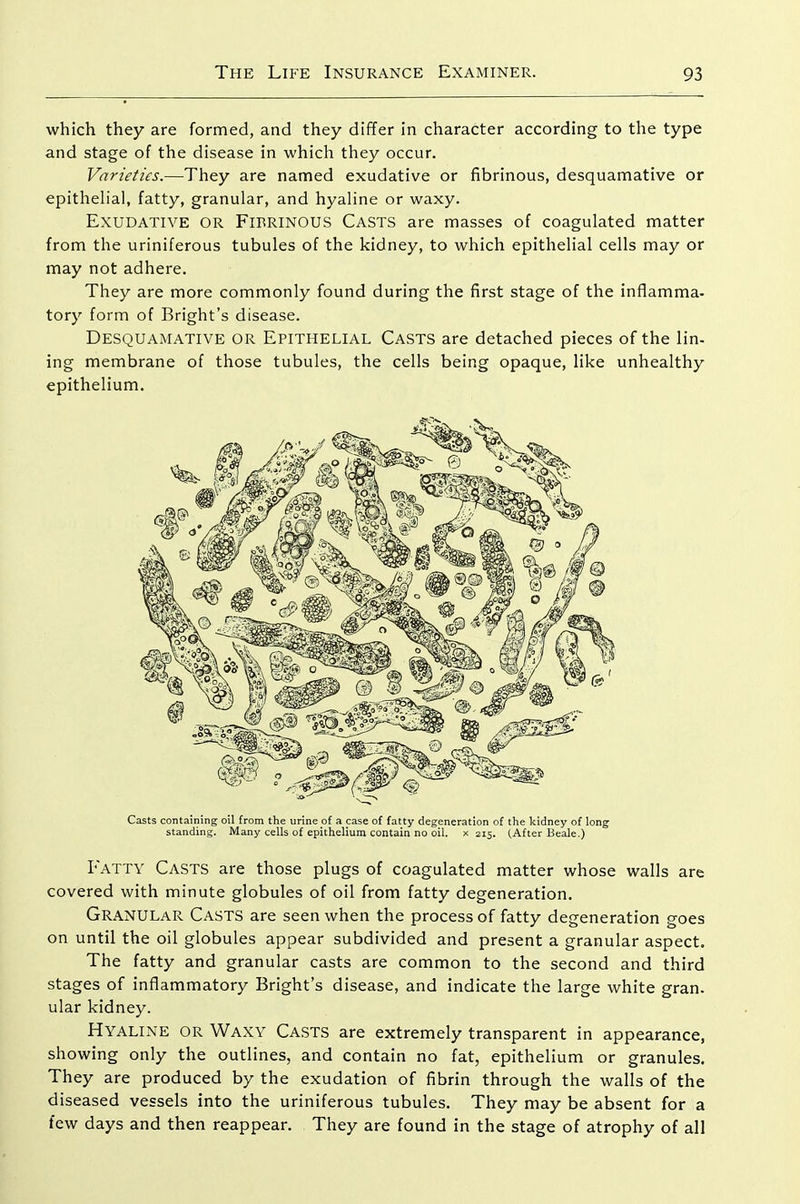 which they are formed, and they dififer in character according to the type and stage of the disease in which they occur. Varieties.—They are named exudative or fibrinous, desquamative or epithelial, fatty, granular, and hyaline or waxy. Exudative or Fibrinous Casts are masses of coagulated matter from the uriniferous tubules of the kidney, to which epithelial cells may or may not adhere. They are more commonly found during the first stage of the inflamma- tory form of Bright's disease. Desquamative or Epithelial Casts are detached pieces of the lin- ing membrane of those tubules, the cells being opaque, like unhealthy epithelium. Casts containing oil from the urine of a case of fatty degeneration of the kidney of long standing. Many cells of epithelium contain no oil. x 215. (.After Beale.) Fatty Casts are those plugs of coagulated matter whose walls are covered with minute globules of oil from fatty degeneration. Granular Casts are seen when the process of fatty degeneration goes on until the oil globules appear subdivided and present a granular aspect. The fatty and granular casts are common to the second and third stages of inflammatory Bright's disease, and indicate the large white gran, ular kidney. Hyaline or Waxy Casts are extremely transparent in appearance, showing only the outlines, and contain no fat, epithelium or granules. They are produced by the exudation of fibrin through the walls of the diseased vessels into the uriniferous tubules. They may be absent for a few days and then reappear. They are found in the stage of atrophy of all