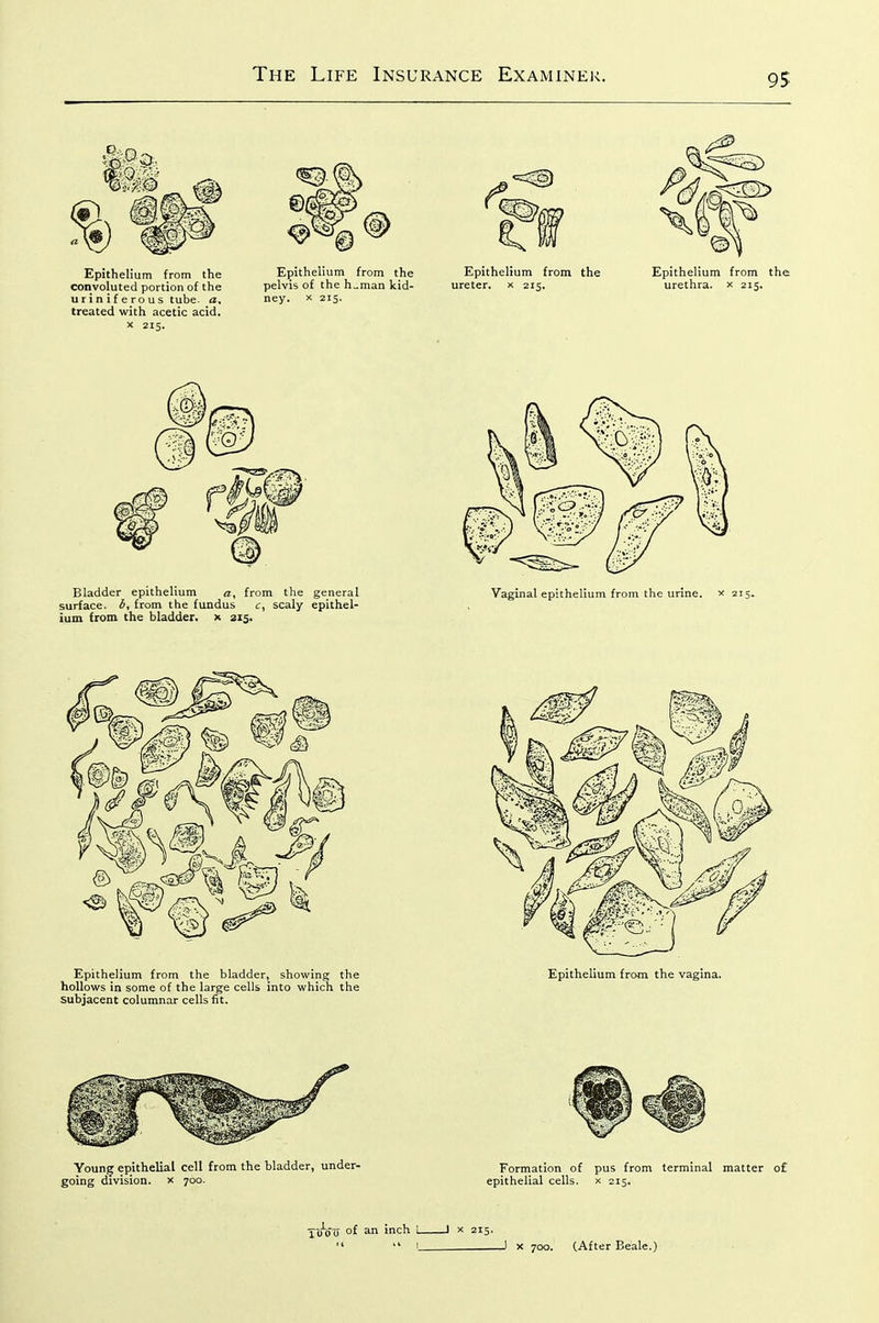 Epithelium from the Epithelium from the Epithelium from the Epithelium from the convoluted portion of the pelvis of the h„man kid- ureter, x 215. urethra, x 215. uriniferous tube, a, ney. x 215. treated with acetic acid. X 215. Bladder epithelium a, from the general surface, b, from the fundus c, scaly epithel- ium from the bladder, x 215. Epithelium from the bladder, showing the hollows in some of the large cells into which the subjacent columnar cells fit. Vaginal epithelium from the urine, x 215. Epithelium from the vagina. T(M)o of an inch 1 1 x 215.  I ^1 X 700. (After Beale.)