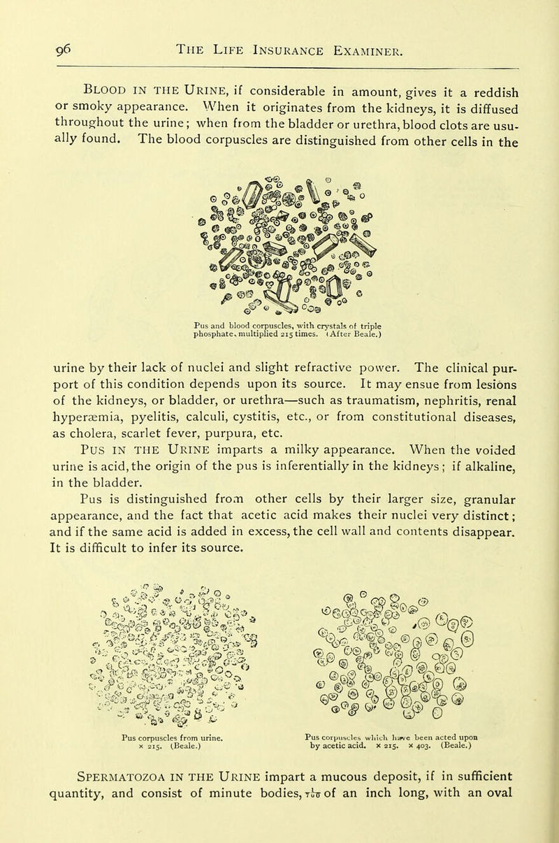 Blood in the Urine, if considerable in amount, gives it a reddish or smoky appearance. When it originates from the kidneys, it is diffused throughout the urine; when from the bladder or urethra, blood clots are usu- ally found. The blood corpuscles are distinguished from other cells in the Pus and blood corpuscles, with crystals of triple phosphate, multiplied 215 times. (After Beale.) urine by their lack of nuclei and slight refractive power. The clinical pur- port of this condition depends upon its source. It may ensue from lesions of the kidneys, or bladder, or urethra—such as traumatism, nephritis, renal hyperaemia, pyelitis, calculi, cystitis, etc., or from constitutional diseases, as cholera, scarlet fever, purpura, etc. Pus IN THE Urine imparts a milky appearance. When the voided urine is acid, the origin of the pus is inferentially in the kidneys ; if alkaline, in the bladder. Pus is distinguished from other cells by their larger size, granular appearance, and the fact that acetic acid makes their nuclei very distinct; and if the same acid is added in excess, the cell wall and contents disappear. It is difficult to infer its source. Pus corpuscles from urine, X 215. (Beale-) Pus corpuscles wliicU have been acted upon by acetic acid, x 215. x 403. (Beale.) Spermatozoa in the Urine impart a mucous deposit, if in sufficient quantity, and consist of minute bodies, jbu of an inch long, with an oval