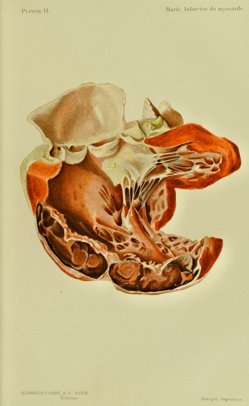 Pi. A N en k II Marie. Iiil'ai’clus du myocarde. GE OI IGE S GAIUIÉ et G. N \ IJ I) E(!il ours Dniooi'r, imprimeur